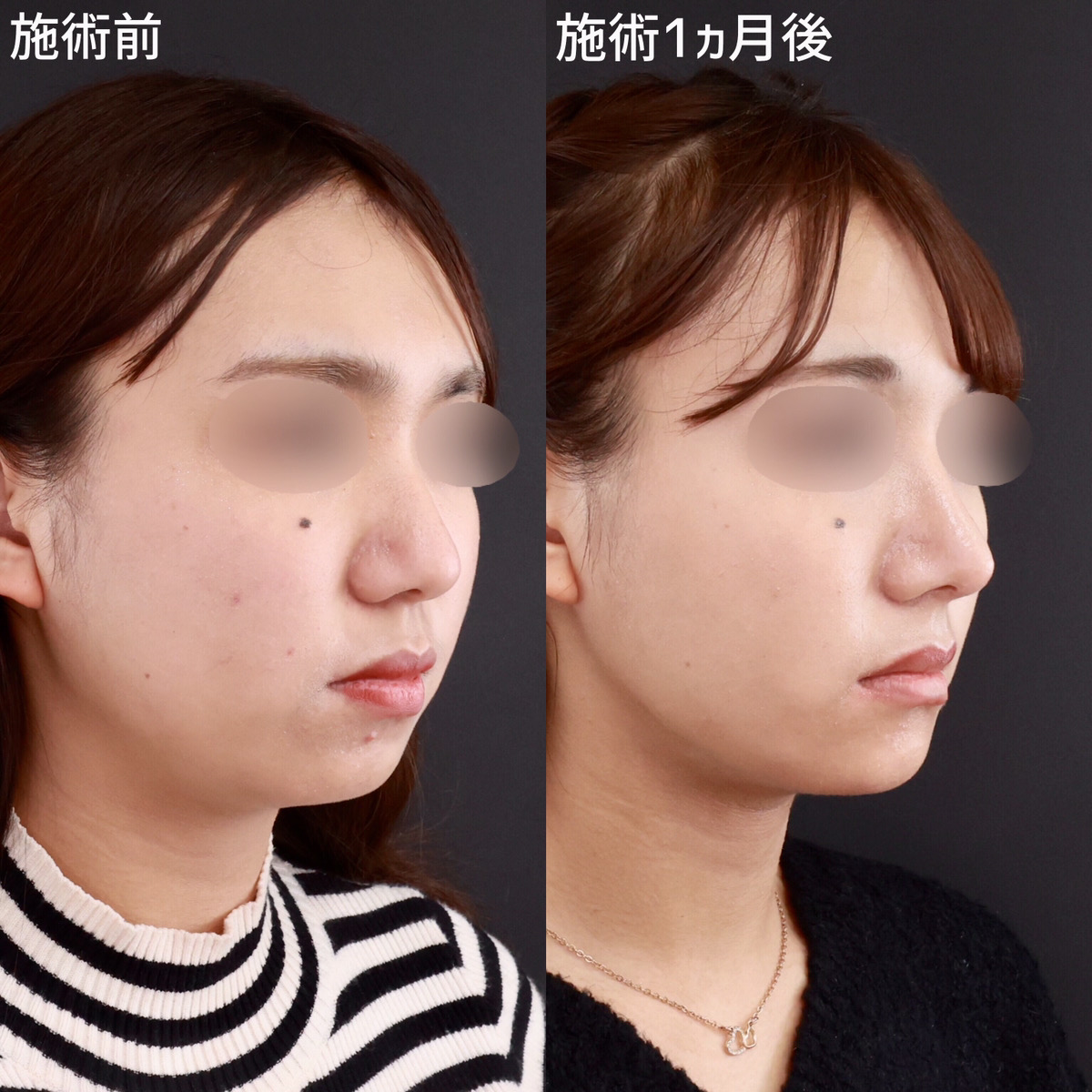 鼻尖形成・鼻尖縮小/鼻先軟骨移植/鼻中隔延長術の症例写真 施術前後 