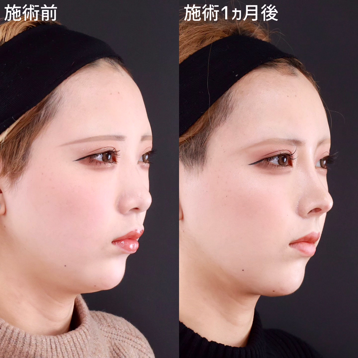 鼻尖形成・鼻尖縮小/鼻先軟骨移植/鼻中隔延長術の症例写真 施術前後 
