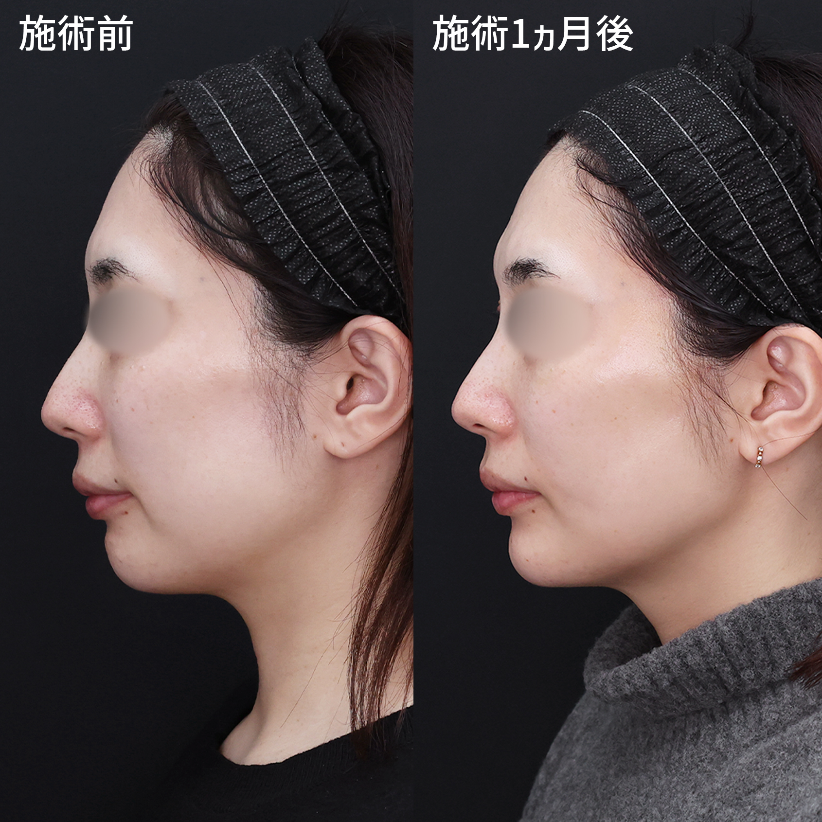 【糸リフト×脂肪除去】で過去の自分より美しく。自然に洗練された輪郭に。