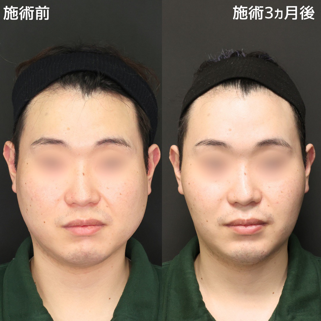TAC式 ツヤ肌コラーゲンリフト®/ジョールファット除去/バッカルファット除去の症例写真 施術前後 
