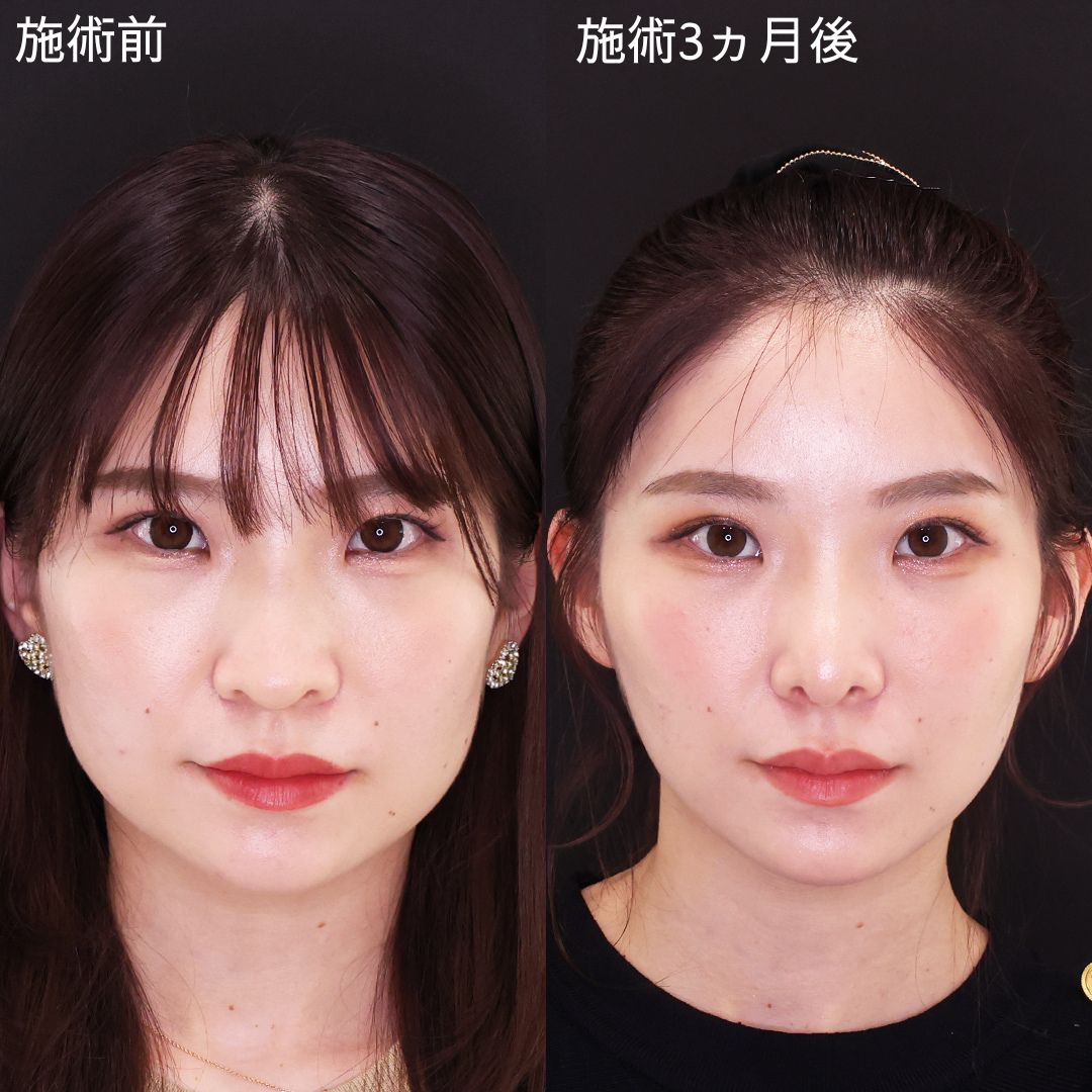 TAC式 ツヤ肌コラーゲンリフト®/エラボトックス注射/顔の脂肪注入(コンデンスリッチフェイス)の症例写真 施術前後 