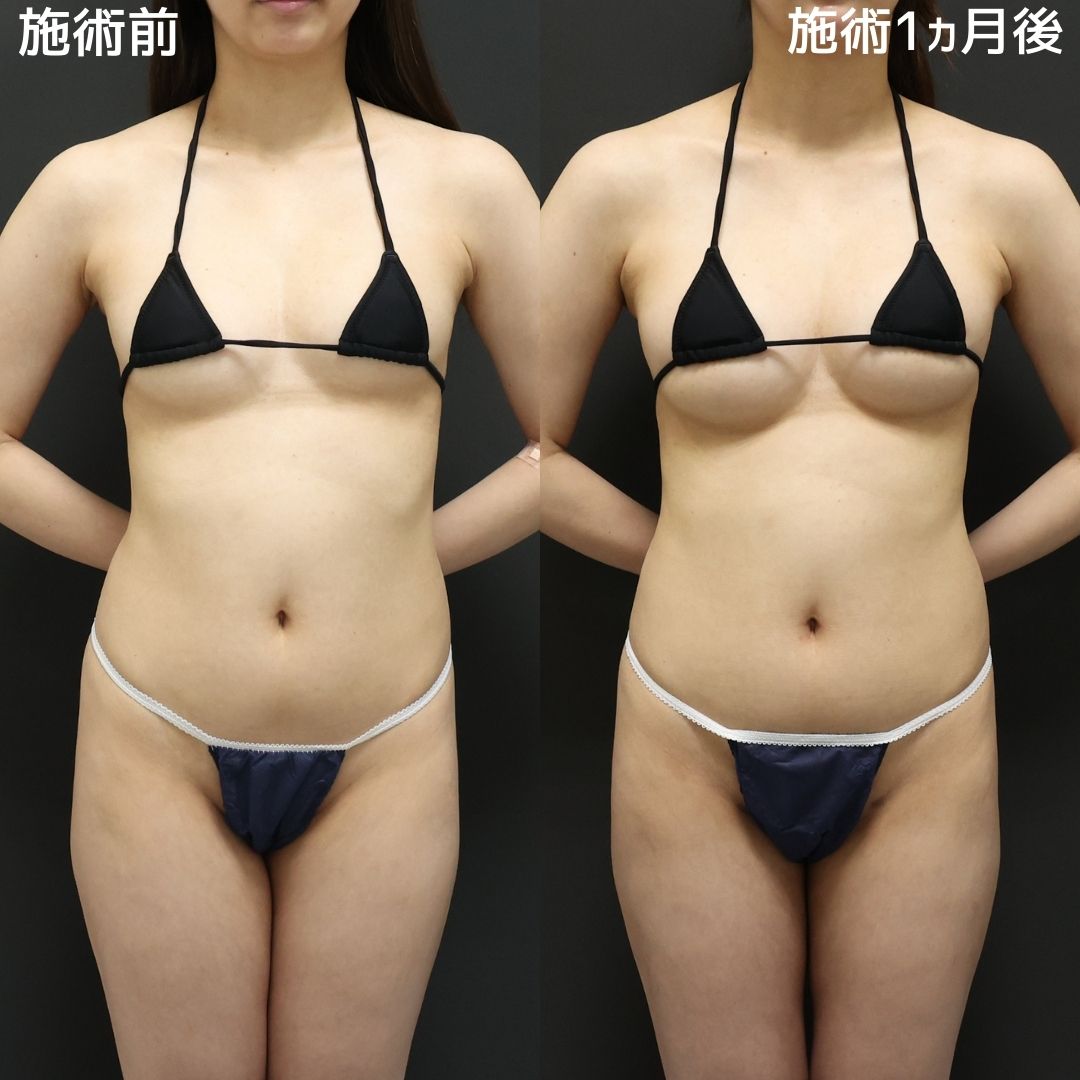 脂肪注入豊胸（コンデンスリッチ・ピュアグラフト・１day脂肪豊胸）の症例写真 施術前後 