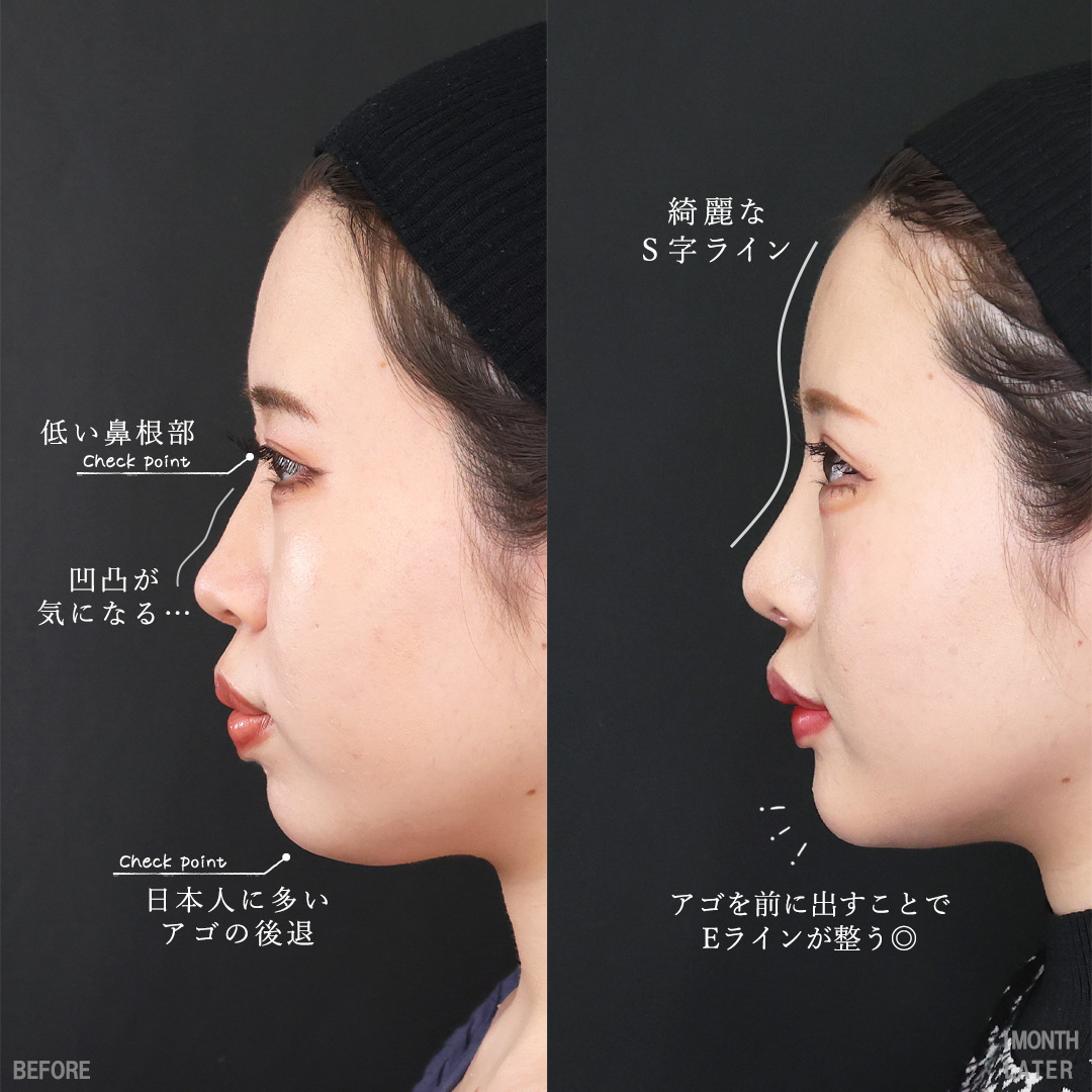 鼻尖形成・鼻尖縮小/鼻先軟骨移植/隆鼻術（プロテーゼ・自家組織）の症例写真 施術前後 