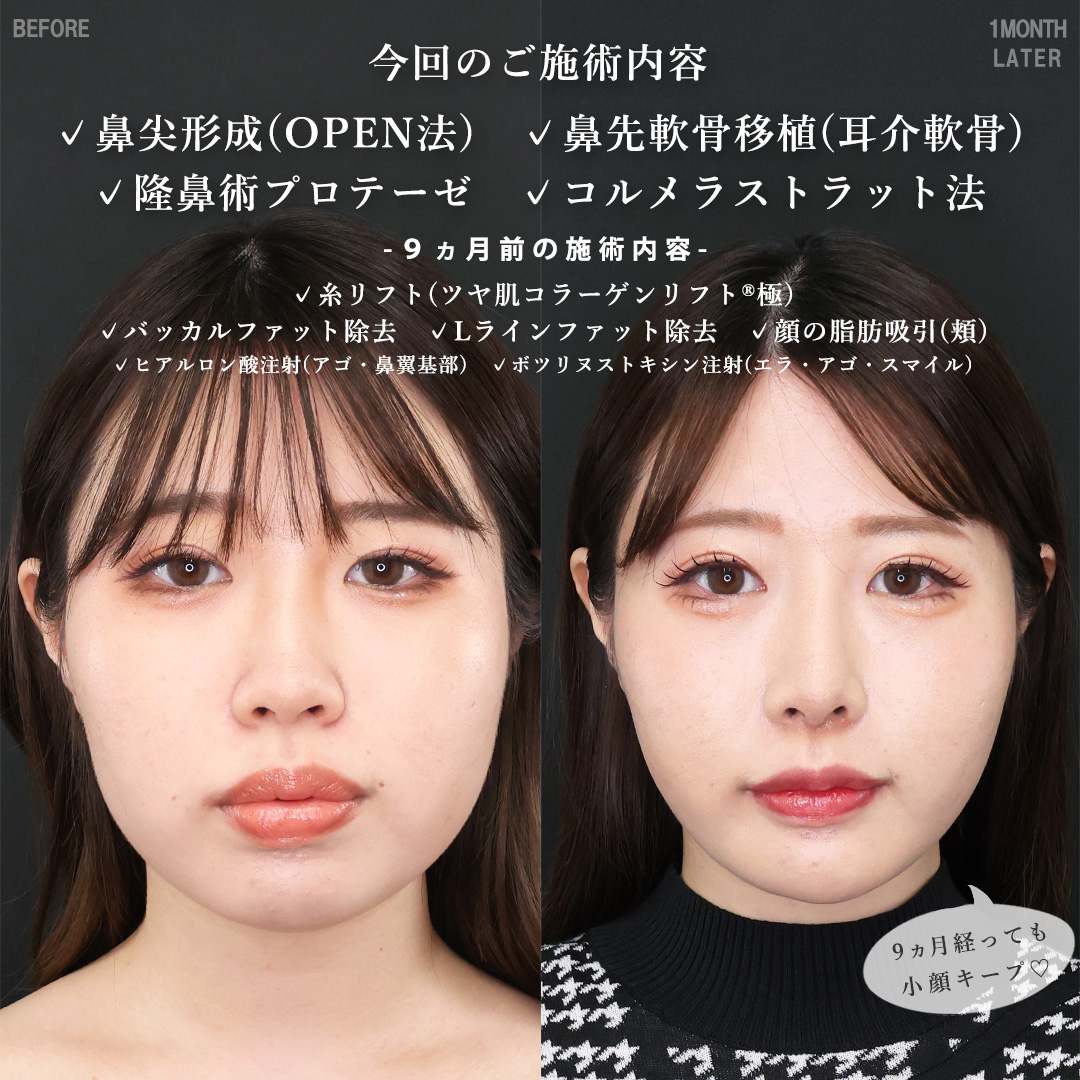 鼻尖形成・鼻尖縮小/鼻先軟骨移植/隆鼻術（プロテーゼ・自家組織）の症例写真 施術前後 
