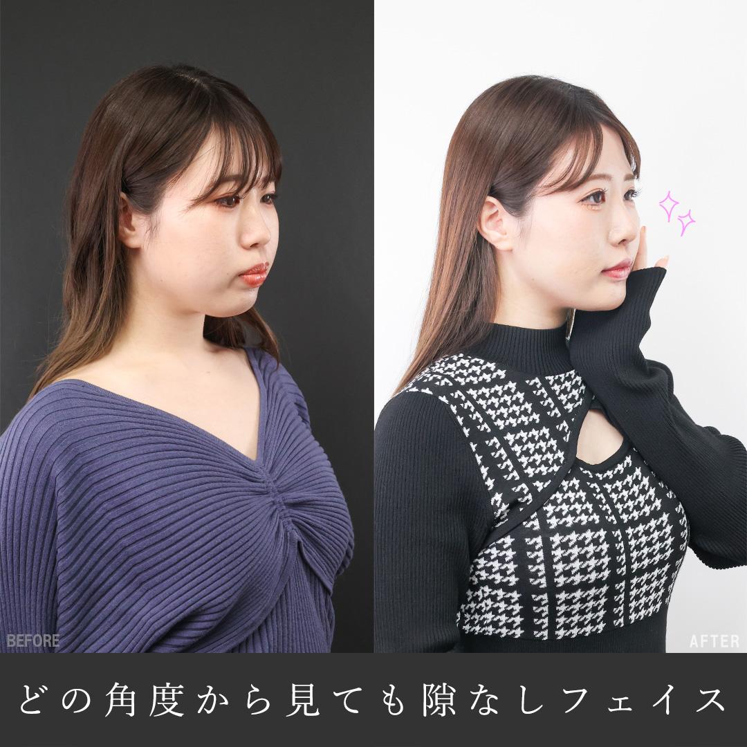 鼻尖形成・鼻尖縮小/鼻先軟骨移植/隆鼻術（プロテーゼ・自家組織）の症例写真 施術前後 