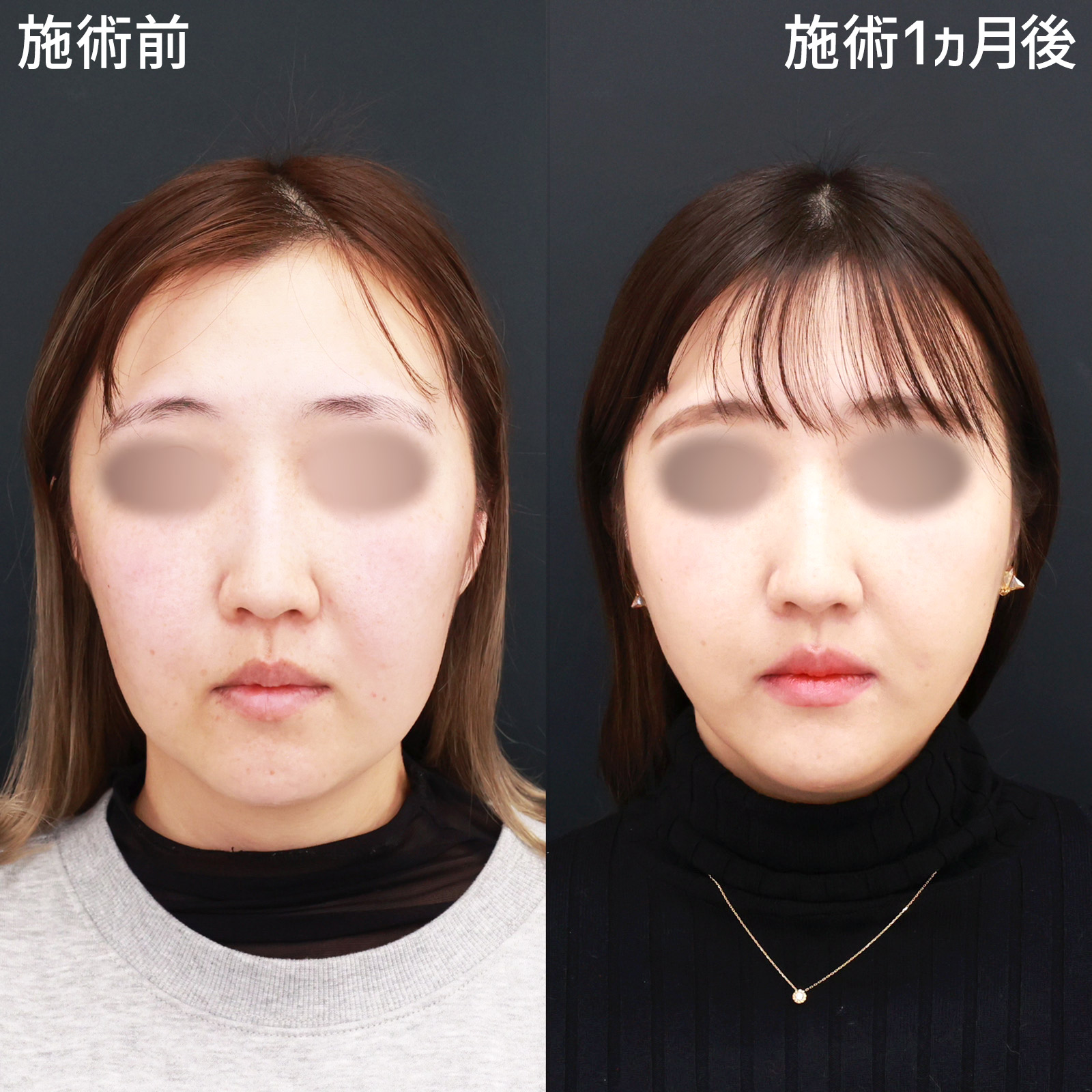 小顔整形 パーフェクトフェイスラインの症例写真 平松医師