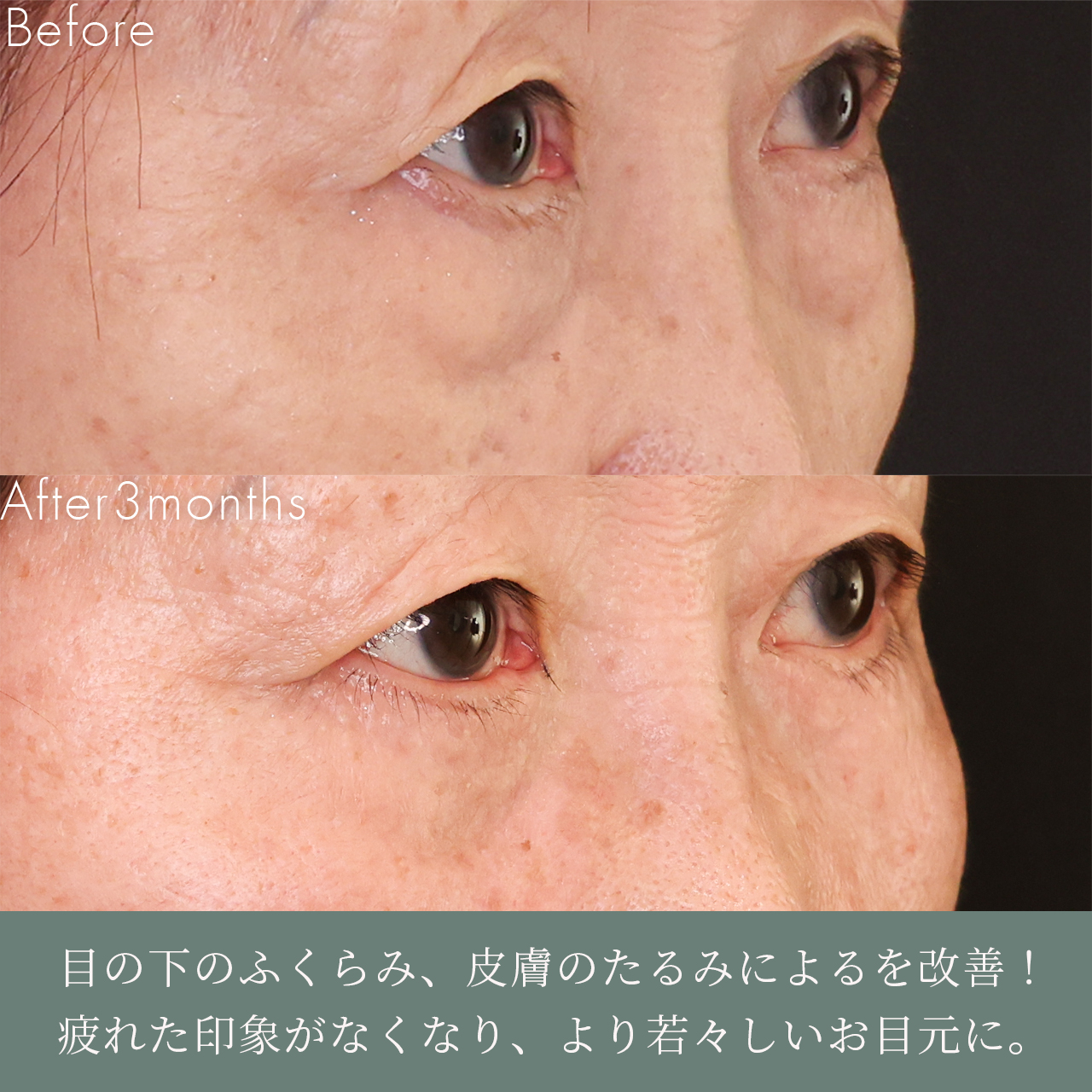 下眼瞼切開術（クマ・たるみとり）/下眼瞼脱脂術（目の下のたるみ取り・目の下の脂肪ふくらみ取り）の症例写真 施術前後 