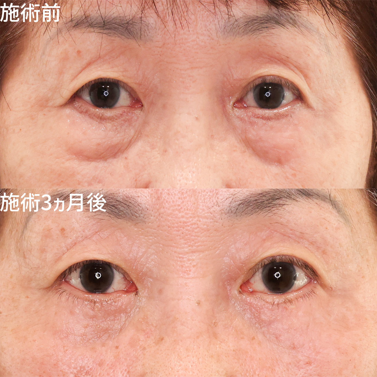 下眼瞼切開術（クマ・たるみとり）/下眼瞼脱脂術（目の下のたるみ取り・目の下の脂肪ふくらみ取り）の症例写真 施術前後 