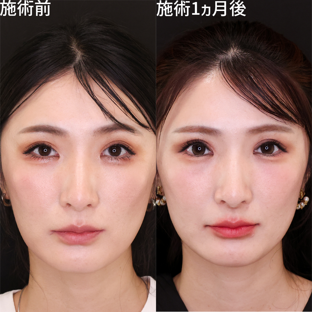 眼瞼下垂（目つき矯正）/上眼瞼切開術/グラマラスライン（タレ目形成）の症例写真 施術前後 
