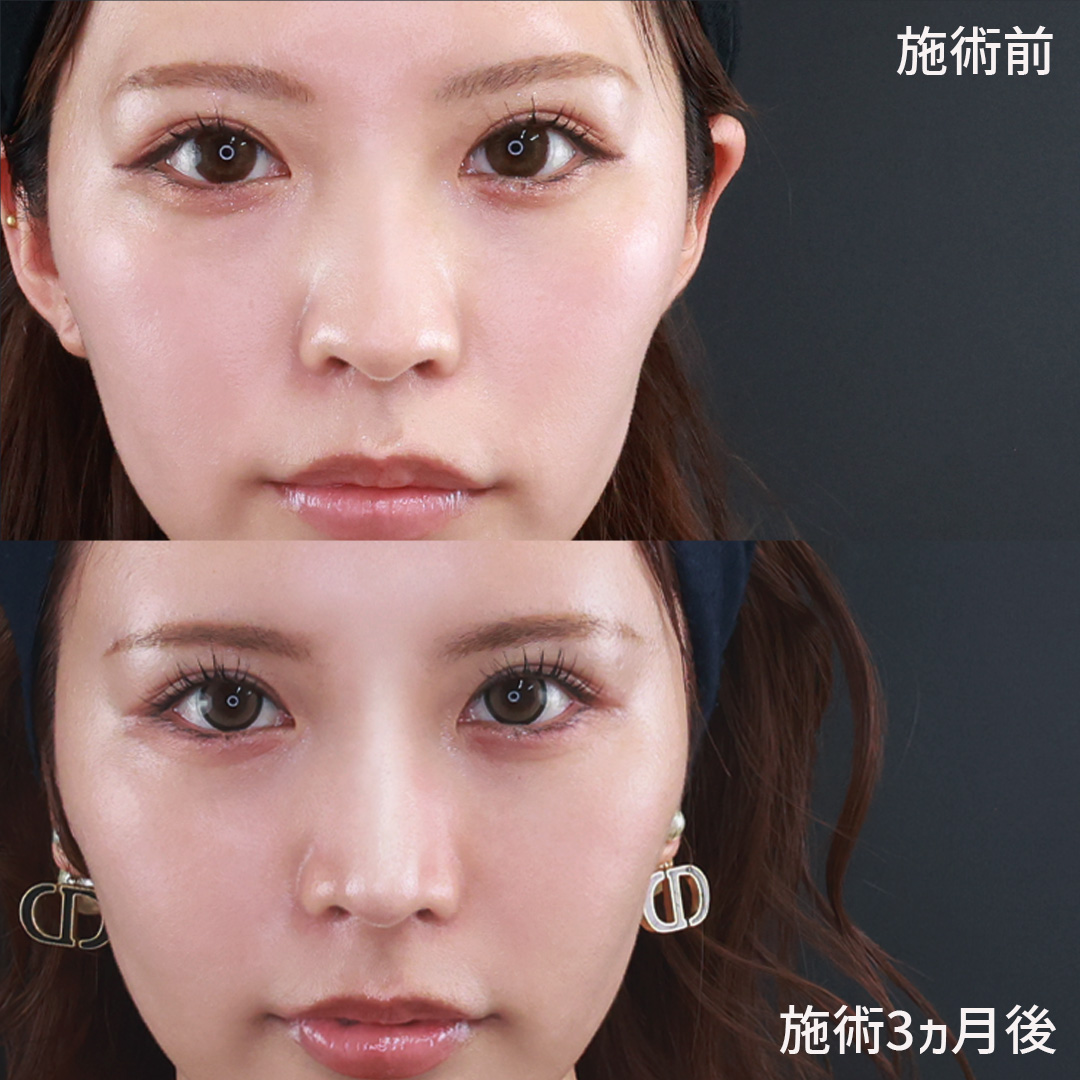鼻中隔延長術/鼻先軟骨移植/鼻尖形成・鼻尖縮小の症例写真 施術前後 