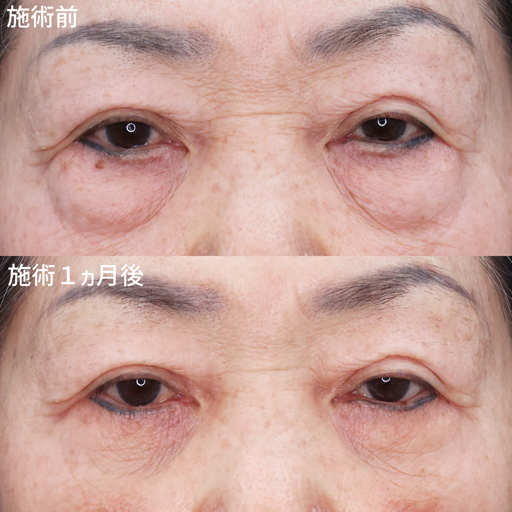 下眼瞼切開術（クマ・たるみとり）/下眼瞼脱脂術（目の下のたるみ取り・目の下の脂肪ふくらみ取り）の症例写真 施術前後 