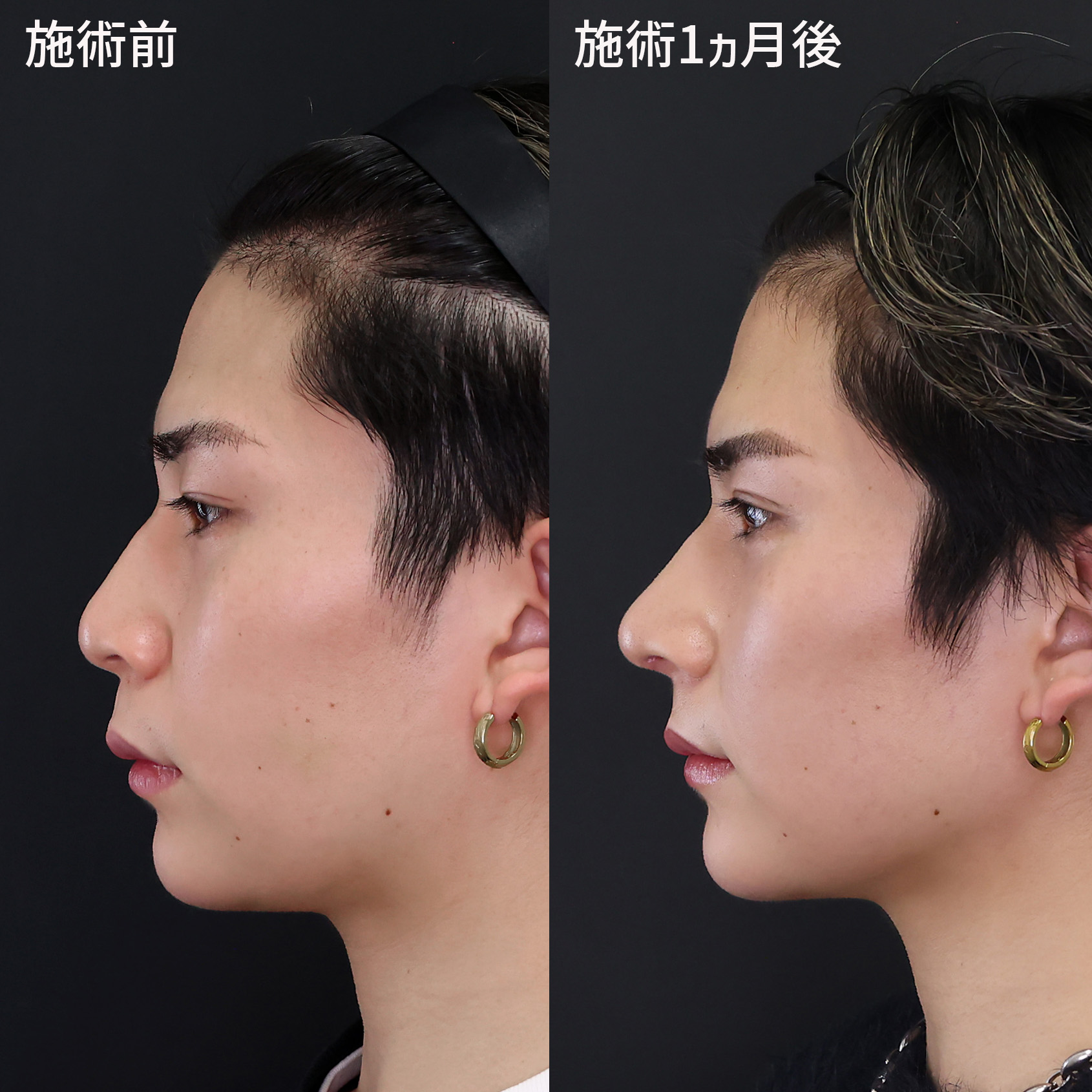 【男の鼻整形】イケメンをつくるオーダーメイド鼻整形
