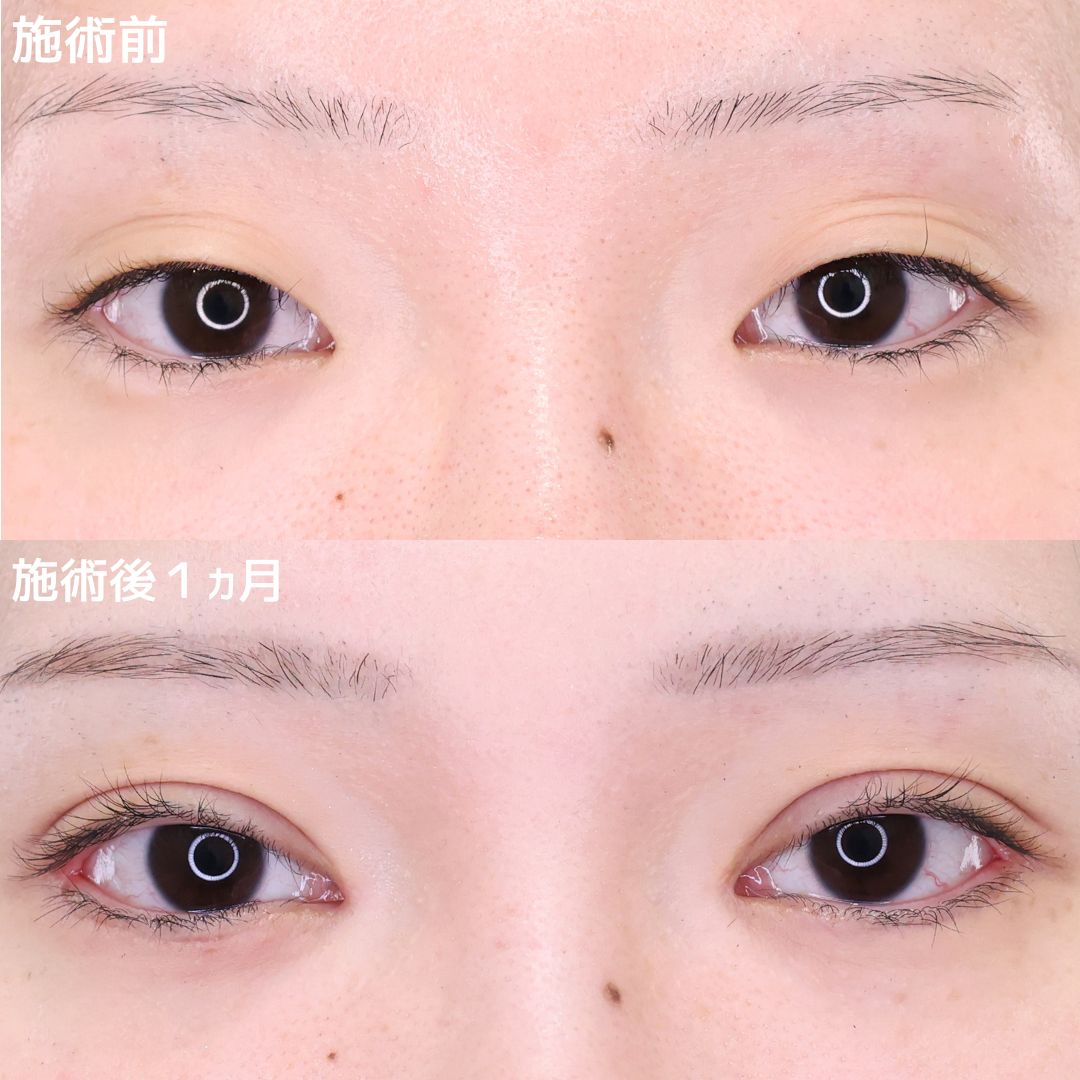 二重埋没法/目頭切開術/目尻切開術の症例写真 施術前後 