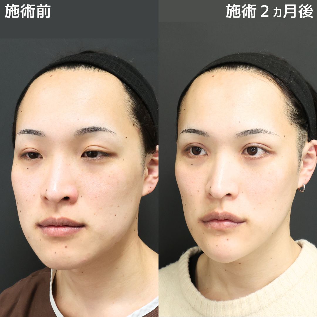 TAC式 ツヤ肌コラーゲンリフト®/Lラインファット除去（エラ下脂肪除去）/下眼瞼脱脂術（目の下のたるみ取り・目の下の脂肪ふくらみ取り）の症例写真 施術前後 