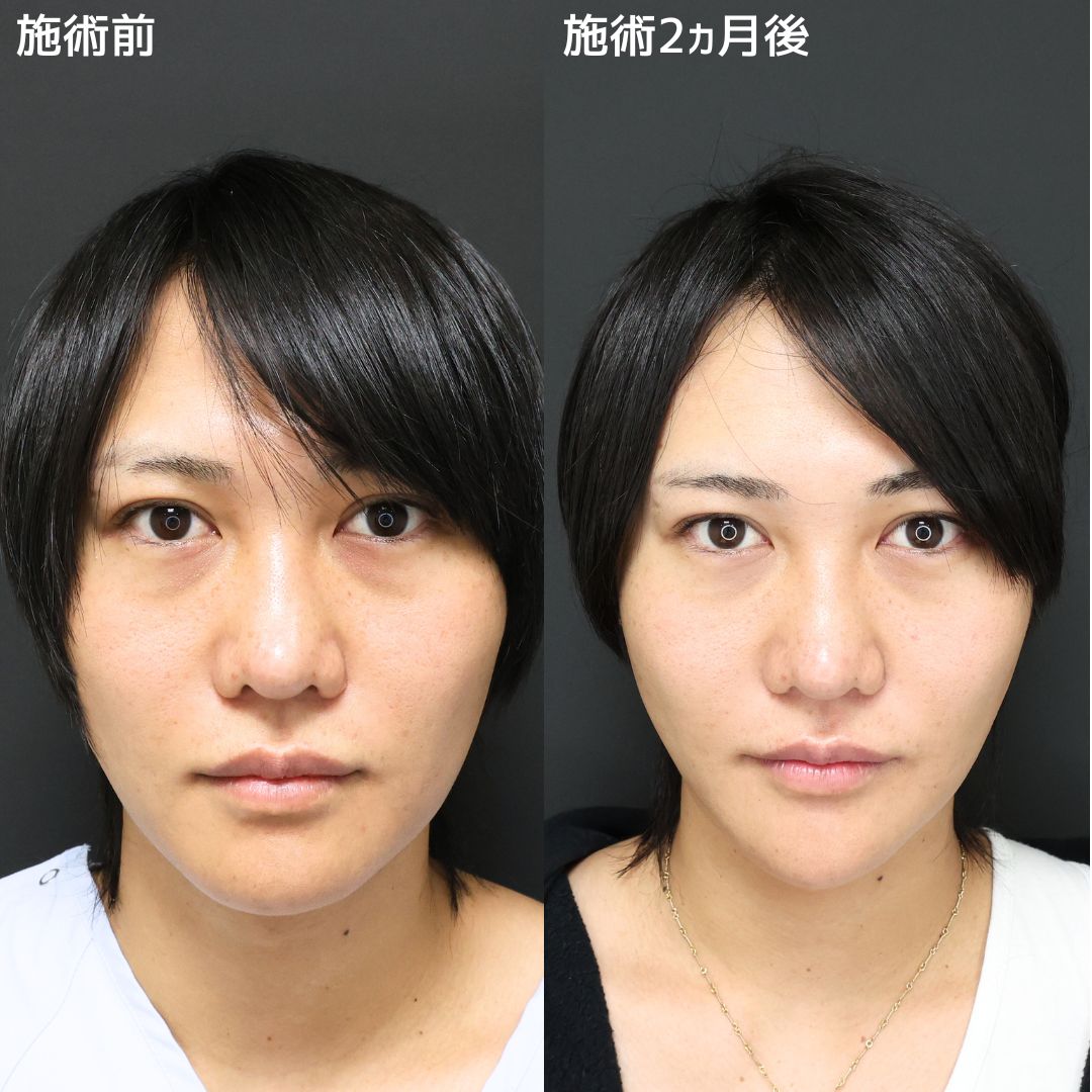 小顔整形｜パーフェクトフェイスライン/顎下の脂肪吸引/Lラインファット除去（エラ下脂肪除去）の症例写真 施術前後 