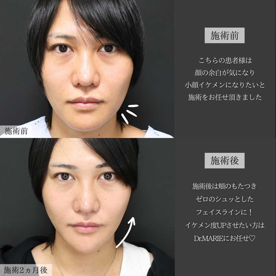 小顔整形｜パーフェクトフェイスライン/顎下の脂肪吸引/Lラインファット除去（エラ下脂肪除去）の症例写真 施術前後 