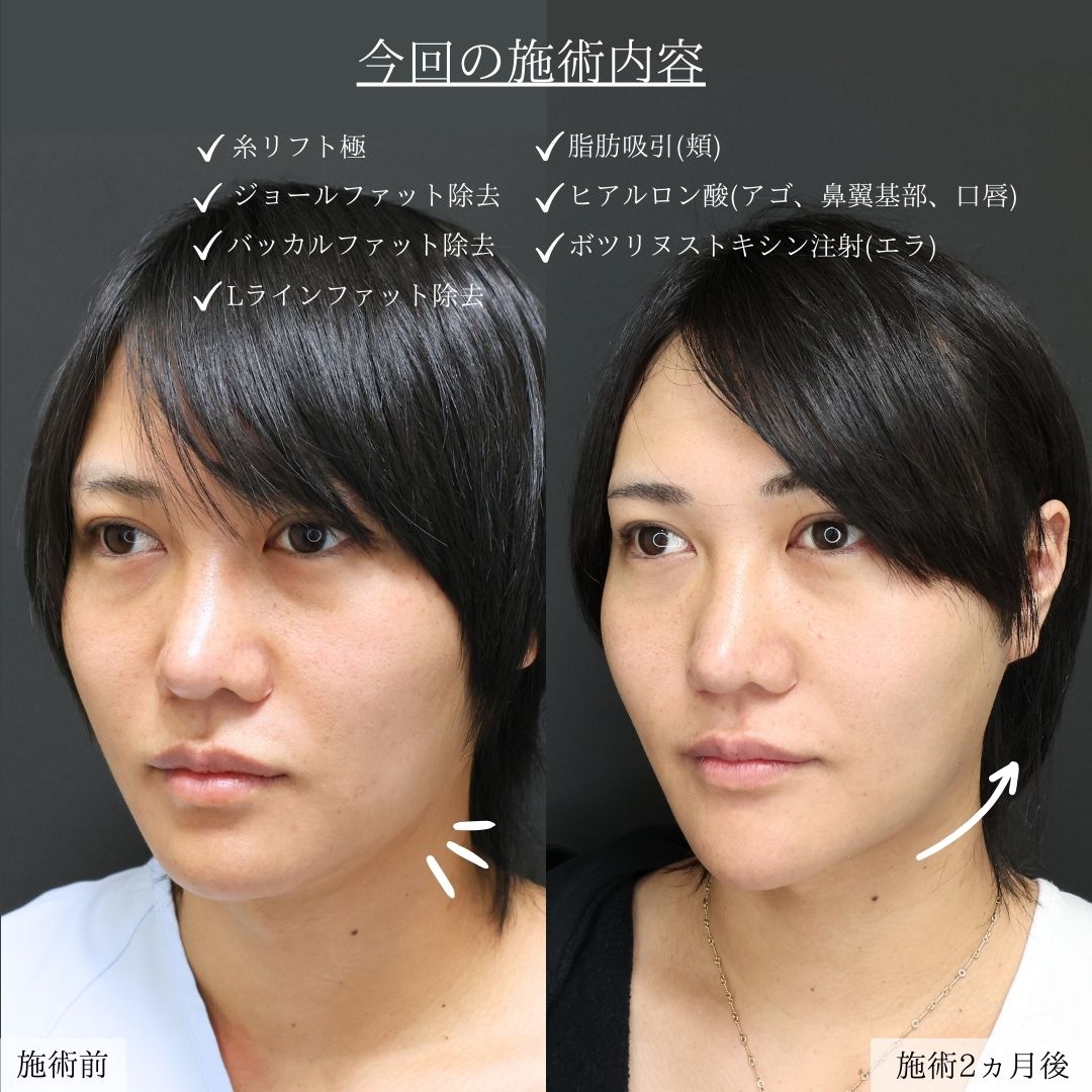 小顔整形｜パーフェクトフェイスライン/顎下の脂肪吸引/Lラインファット除去（エラ下脂肪除去）の症例写真 施術前後 