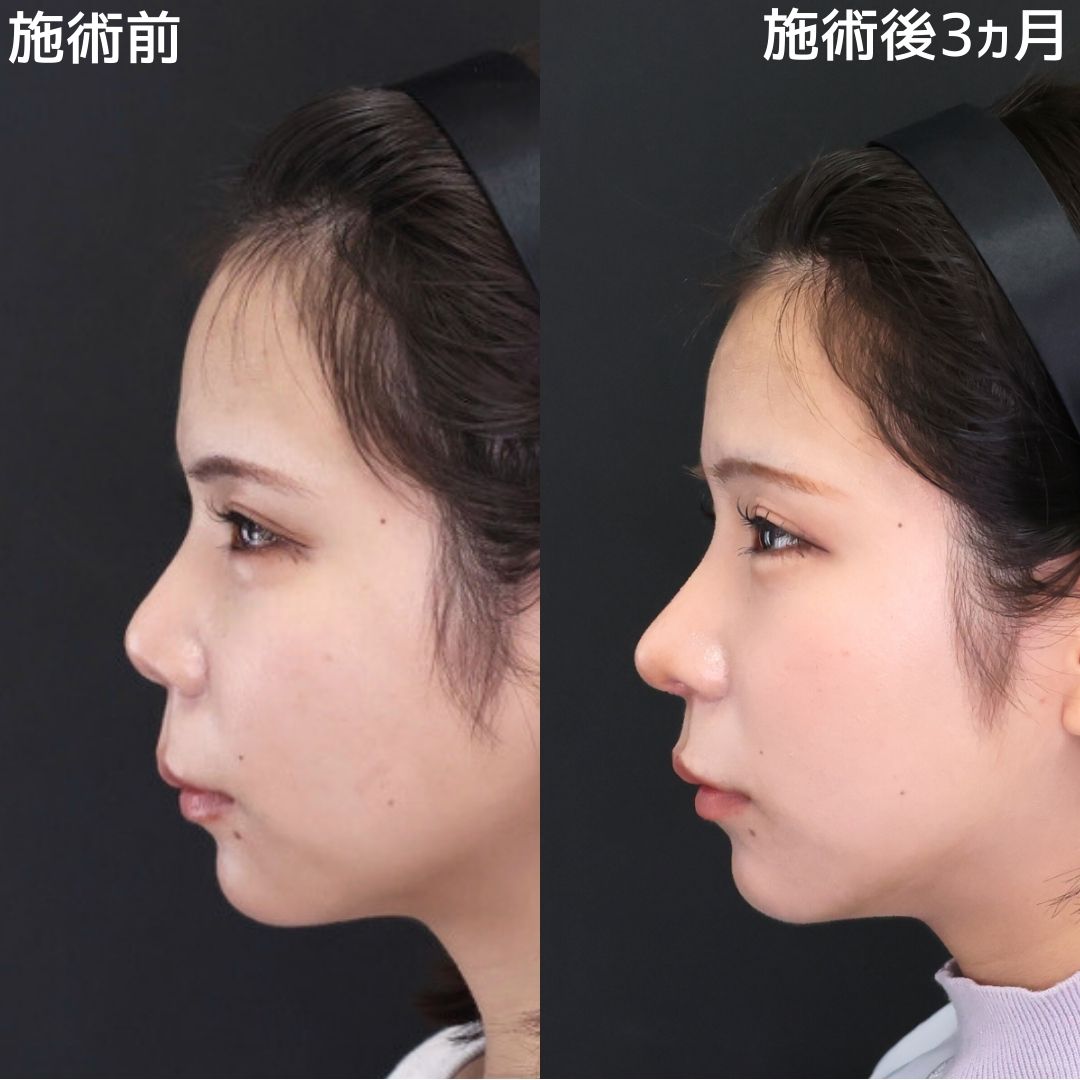 鼻尖形成・鼻尖縮小/鼻先軟骨移植/鼻中隔延長術の症例写真 施術前後 