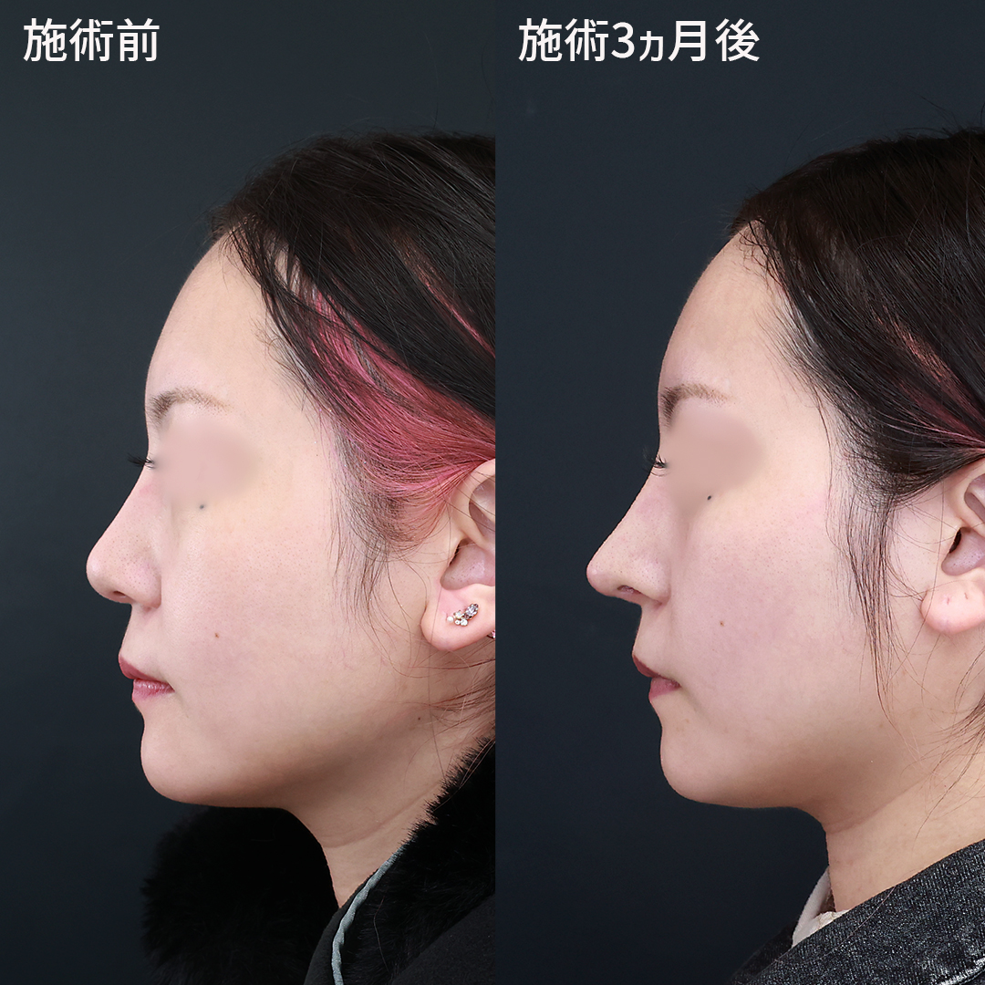 鼻中隔延長術/鼻先軟骨移植/鼻尖形成・鼻尖縮小の症例写真 施術前後 