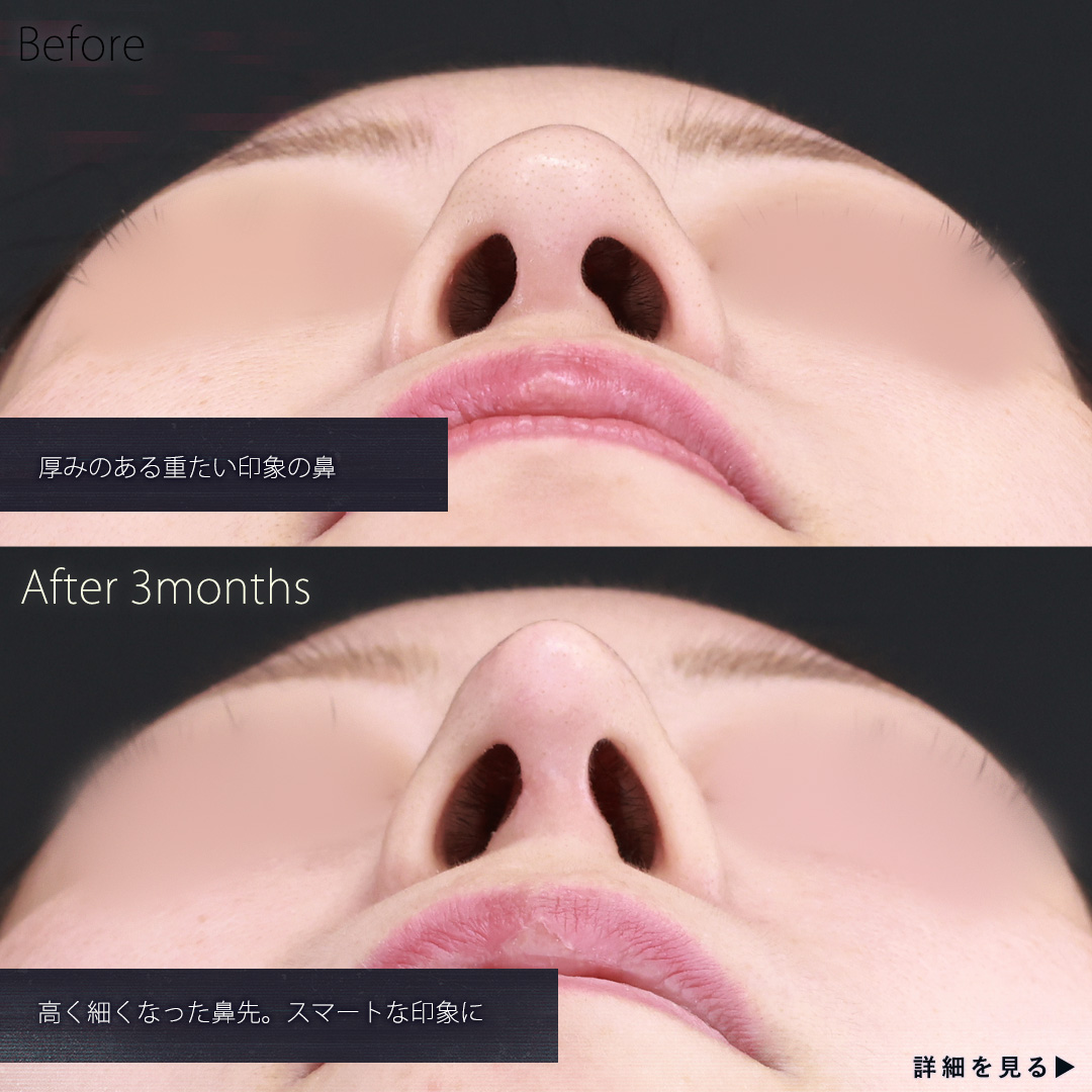 鼻中隔延長術/鼻先軟骨移植/鼻尖形成・鼻尖縮小の症例写真 施術前後 