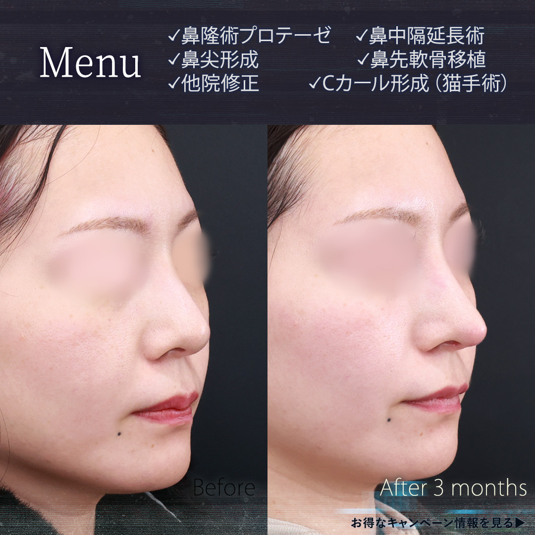 鼻中隔延長術/鼻先軟骨移植/鼻尖形成・鼻尖縮小の症例写真 施術前後 