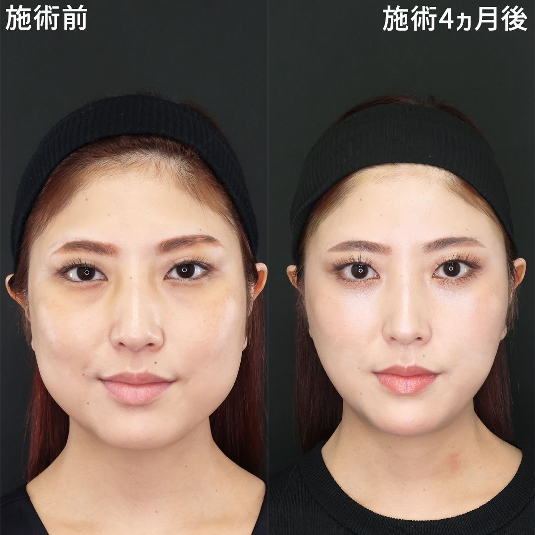 下眼瞼脱脂術（目の下のたるみ取り・目の下の脂肪ふくらみ取り）/TAC式 ツヤ肌コラーゲンリフト®/バッカルファット除去の症例写真 施術前後 