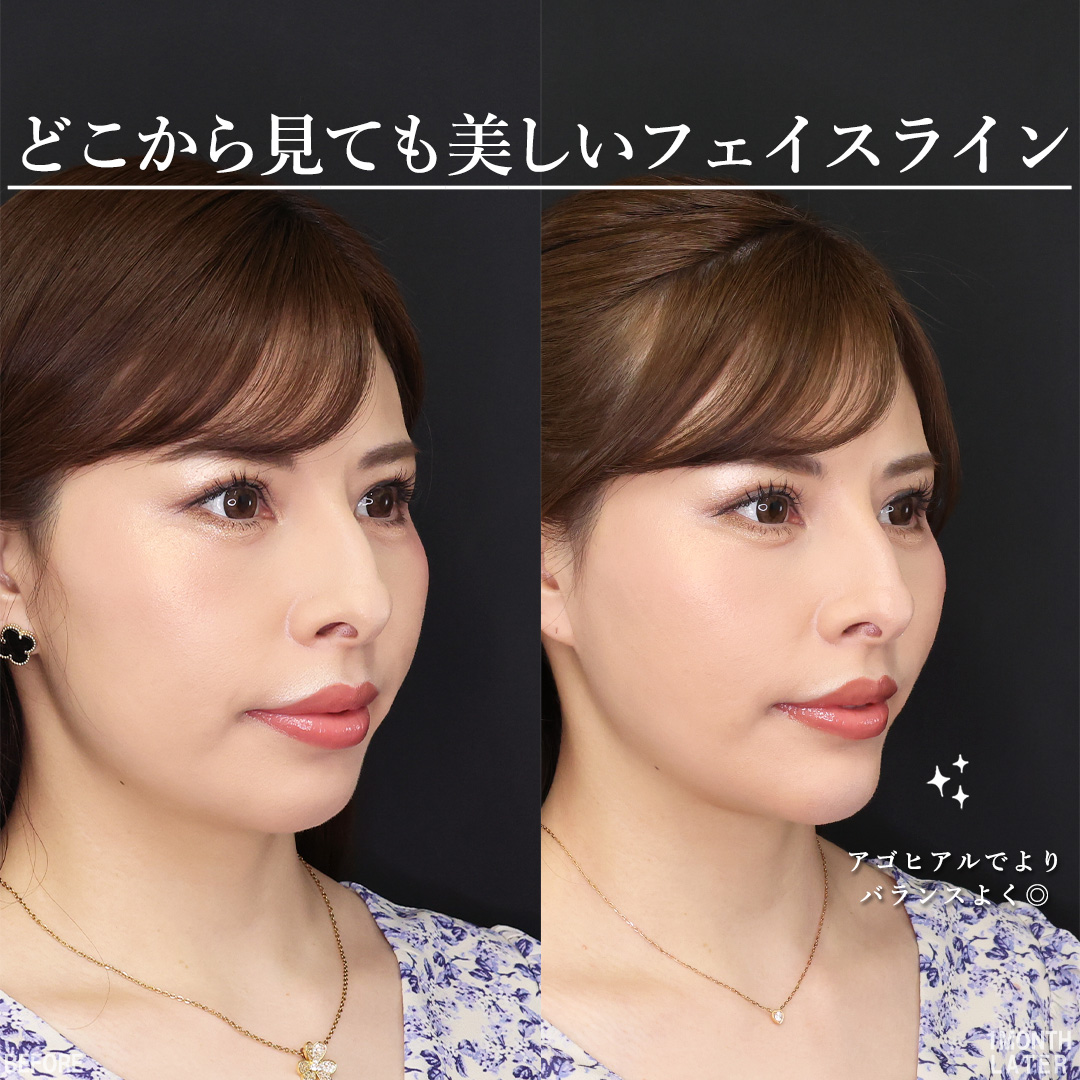 TAC式 ツヤ肌コラーゲンリフト®/顎下の脂肪吸引/Lラインファット除去（エラ下脂肪除去）の症例写真 施術前後 