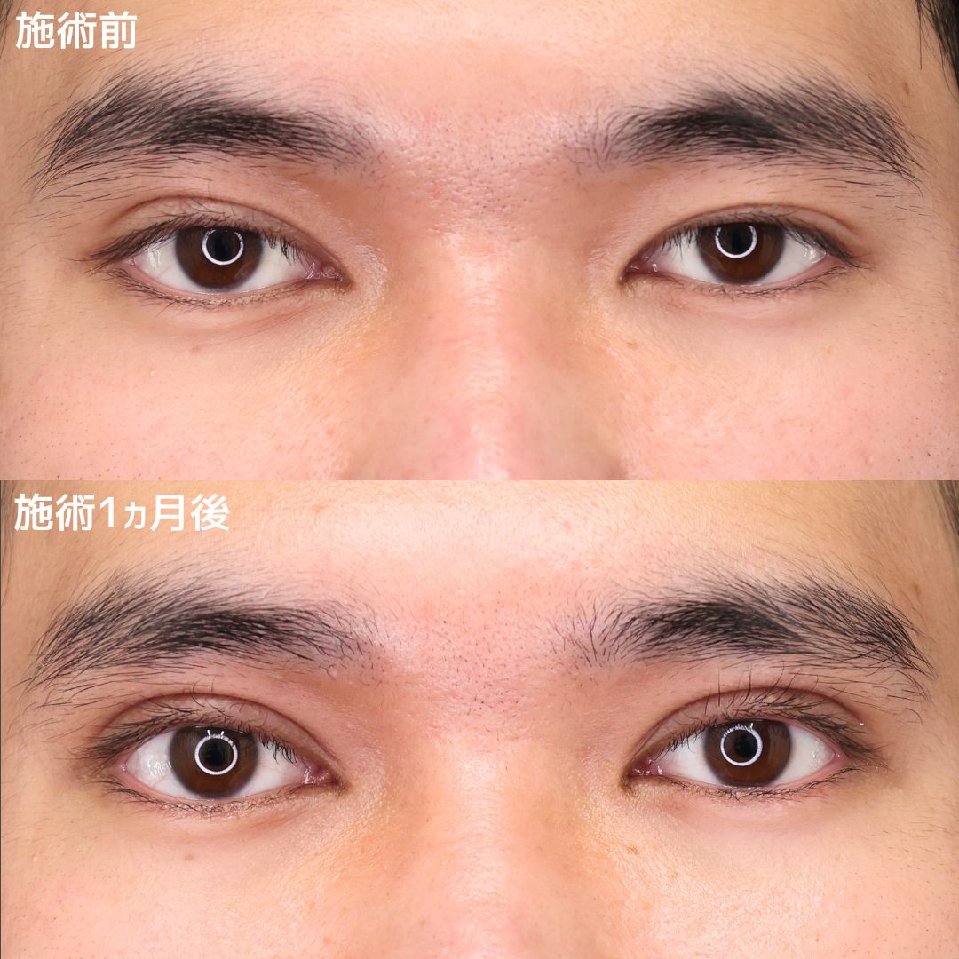 上眼瞼切開術の症例写真 施術前後 