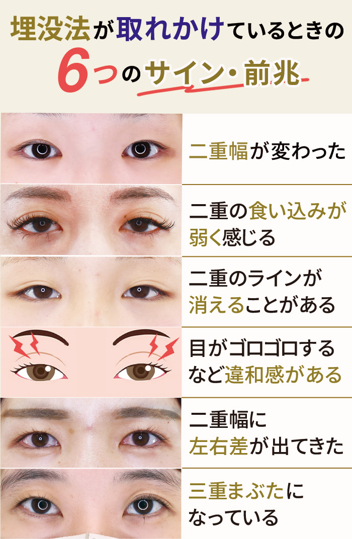 埋没法が取れかけているときの6つのサイン と前兆【症例写真あり】