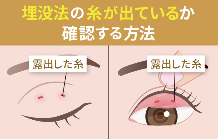 埋没の糸が出ているか確認する