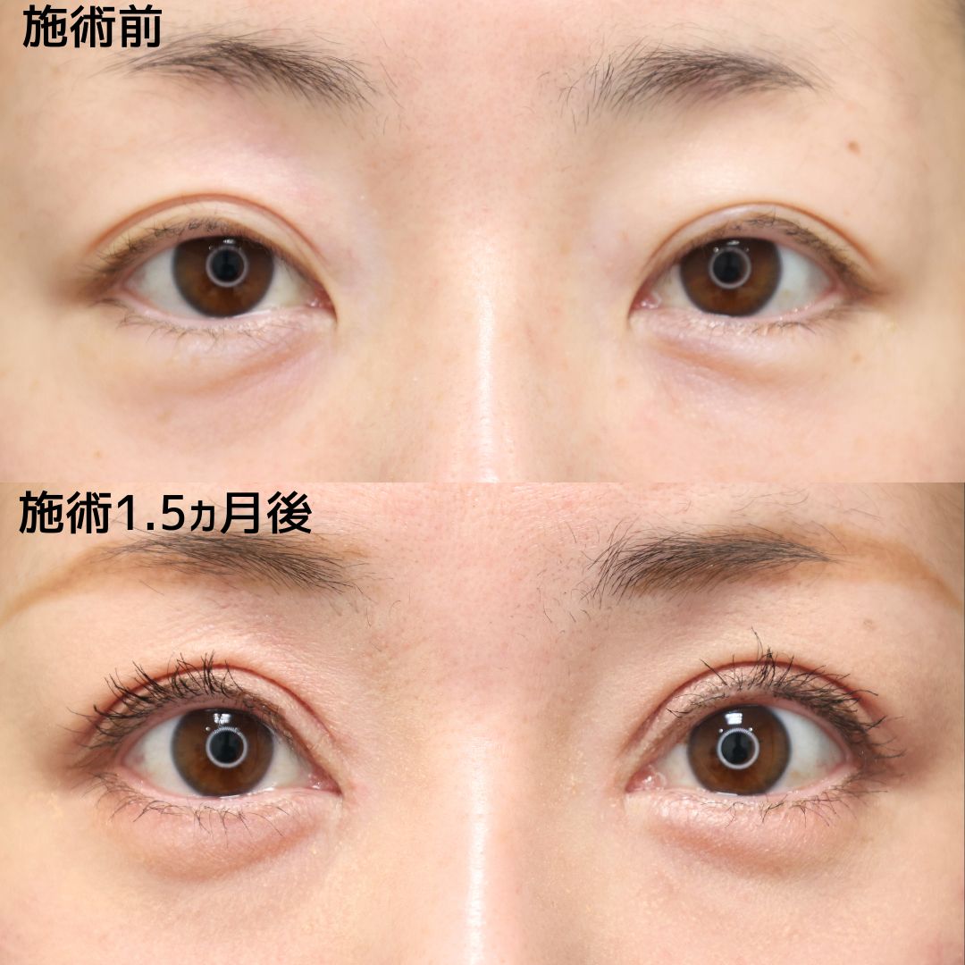 上眼瞼切開術/眼瞼下垂（目つき矯正）/目頭切開術の症例写真 施術前後 