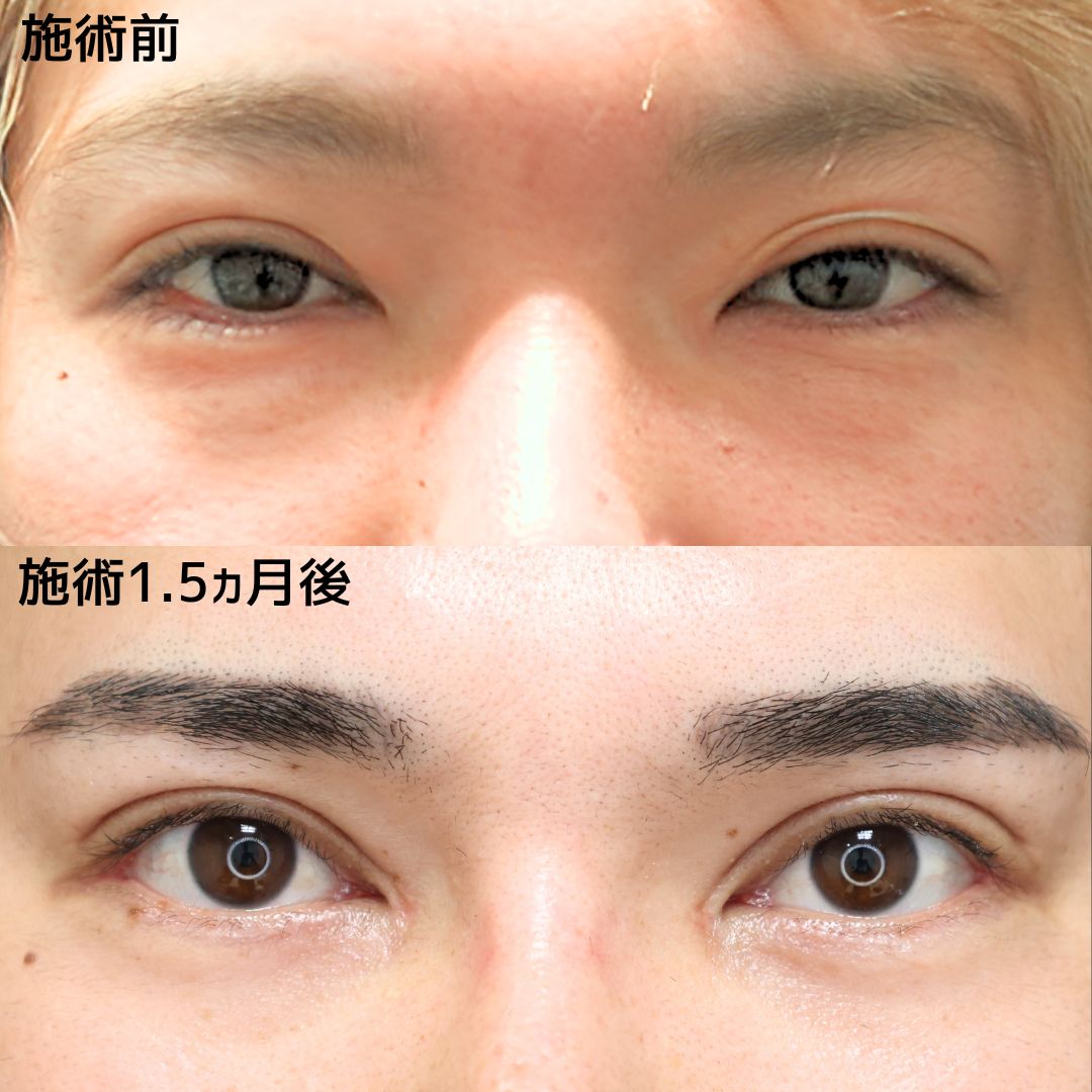 上眼瞼切開術/目頭切開術/目尻切開術の症例写真 施術前後 