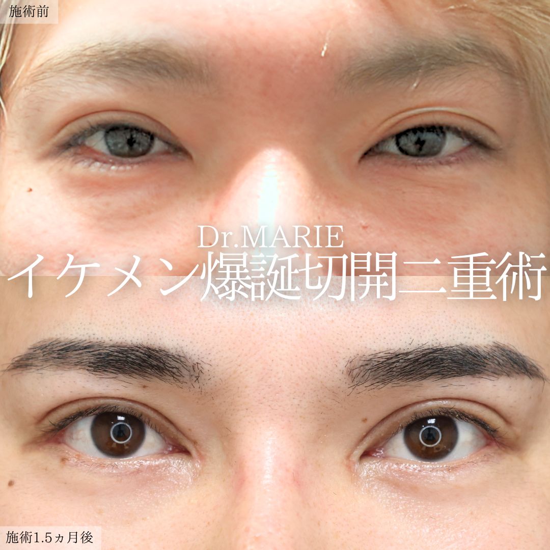 上眼瞼切開術/目頭切開術/目尻切開術の症例写真 施術前後 