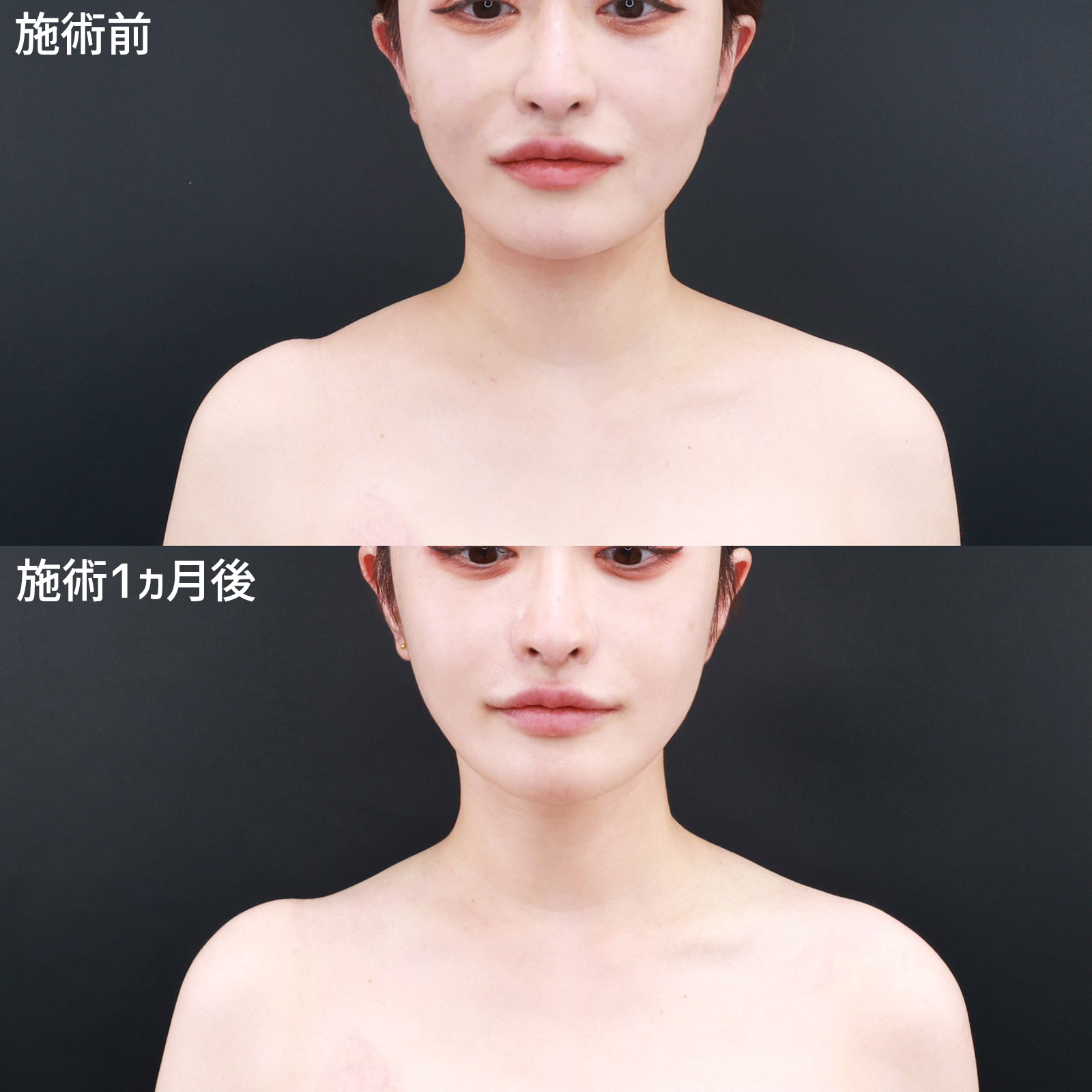 首･肩ボトックス注射の症例写真 施術前後 