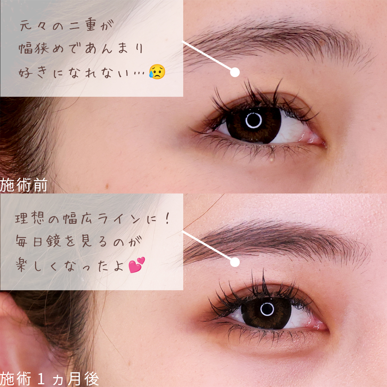 二重埋没法の症例写真 施術前後 