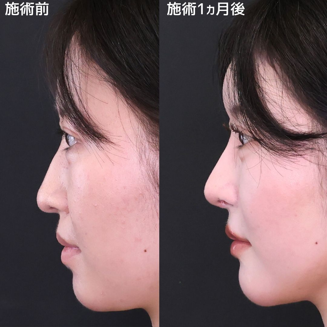 鼻先軟骨移植/鼻尖形成・鼻尖縮小/隆鼻術（プロテーゼ・自家組織）の症例写真 施術前後 