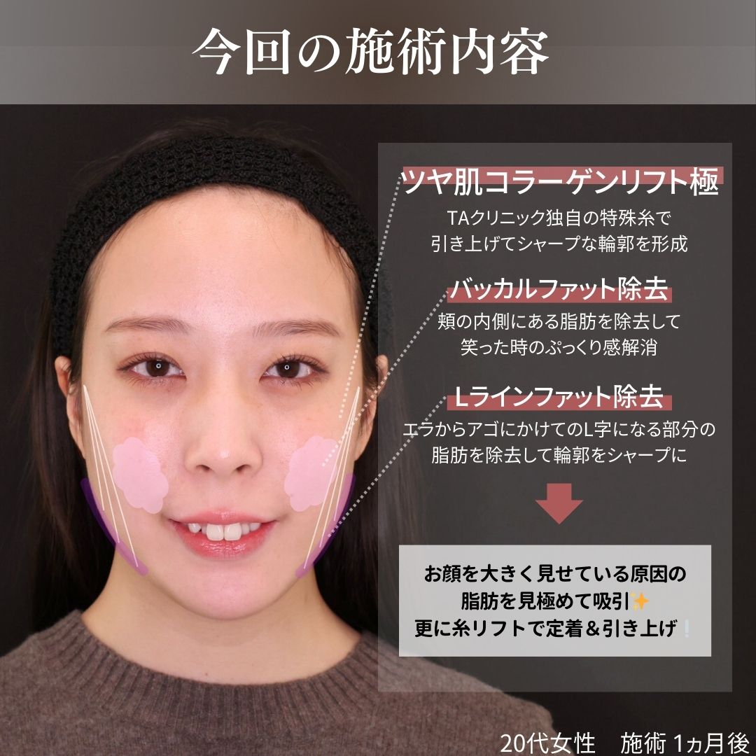TAC式 ツヤ肌コラーゲンリフト®/バッカルファット除去/Lラインファット除去（エラ下脂肪除去）の症例写真 施術前後 