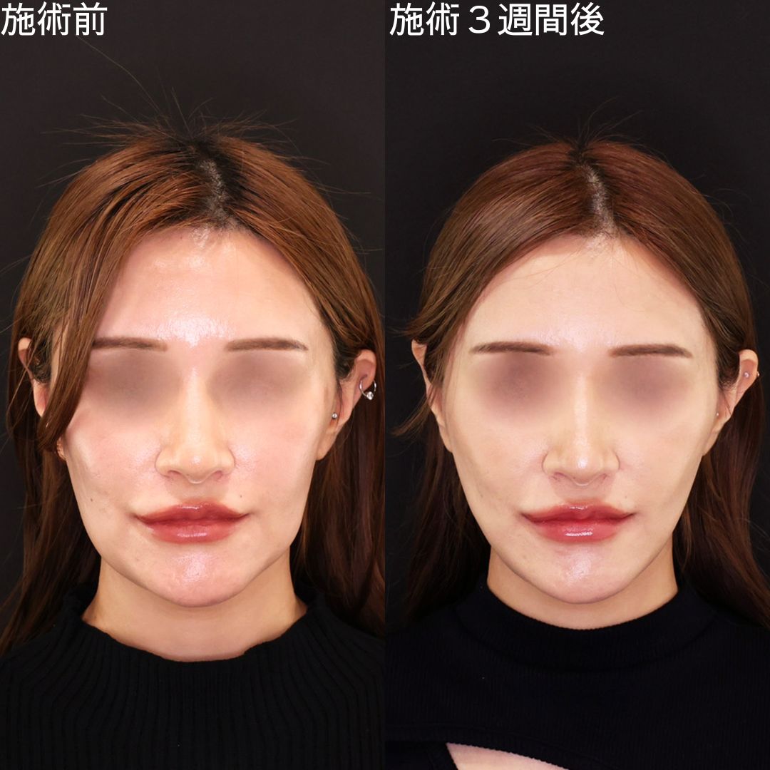 TAC式 ツヤ肌コラーゲンリフト®の症例写真 施術前後 