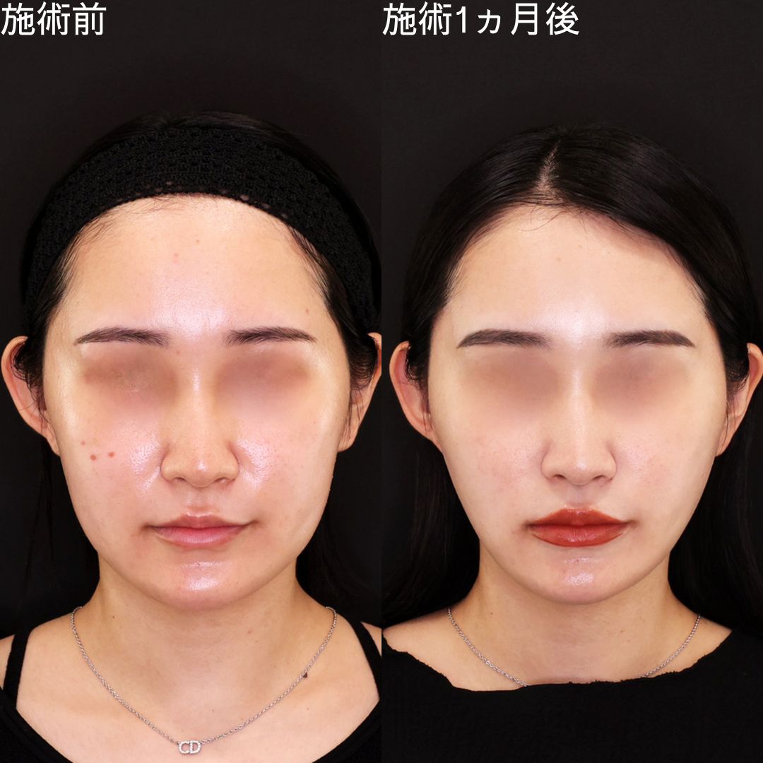 TAC式 ツヤ肌コラーゲンリフト®/ジョールファット除去/エラボトックス注射の症例写真 施術前後 