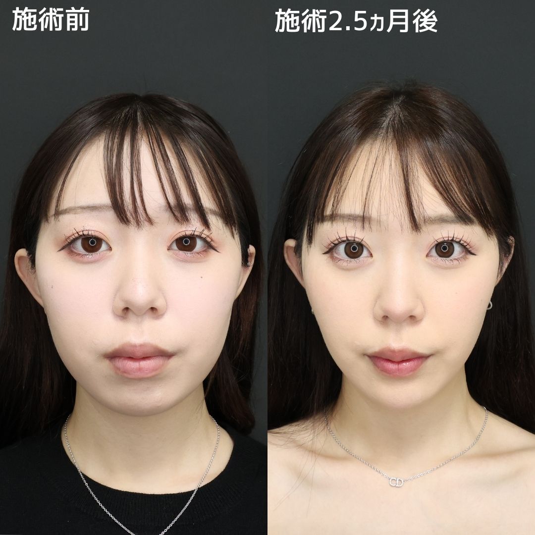 顎下の脂肪吸引/ジョールファット除去/バッカルファット除去の症例写真 施術前後 