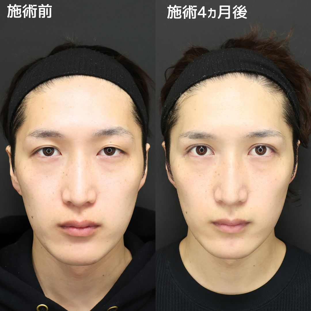 上眼瞼切開術/眼瞼下垂（目つき矯正）の症例写真 施術前後 