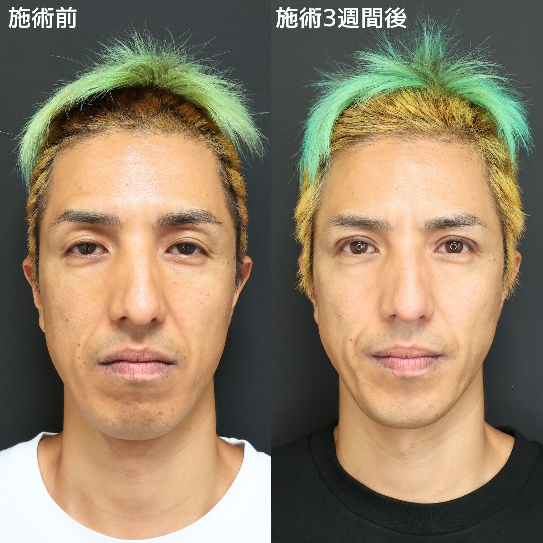 二重切開（全切開法）/上眼瞼切開術の症例写真 施術前後 