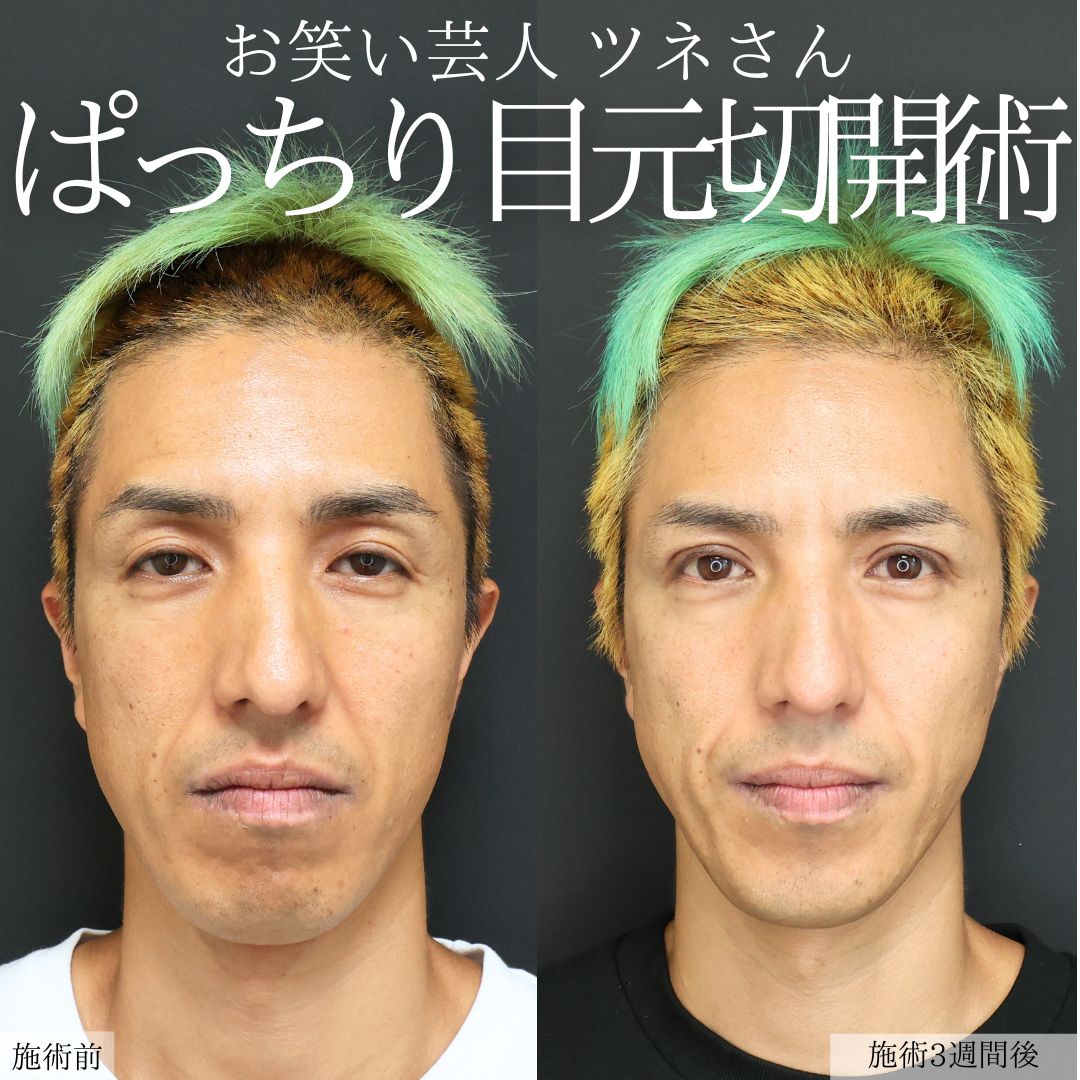 二重切開（全切開法）/上眼瞼切開術の症例写真 施術前後 