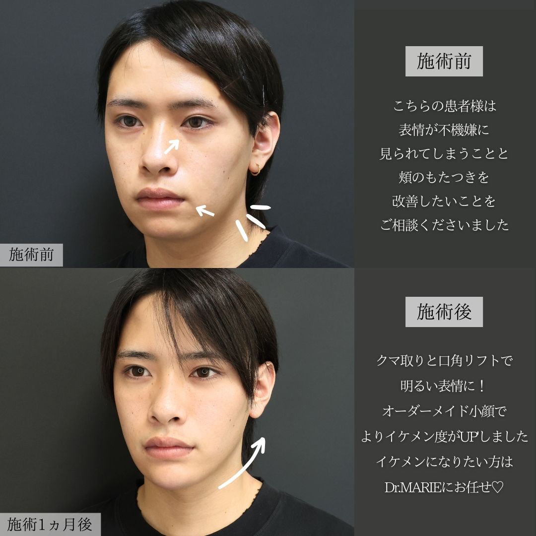バッカルファット除去/エラボトックス注射/顎下の脂肪吸引の症例写真 施術前後 