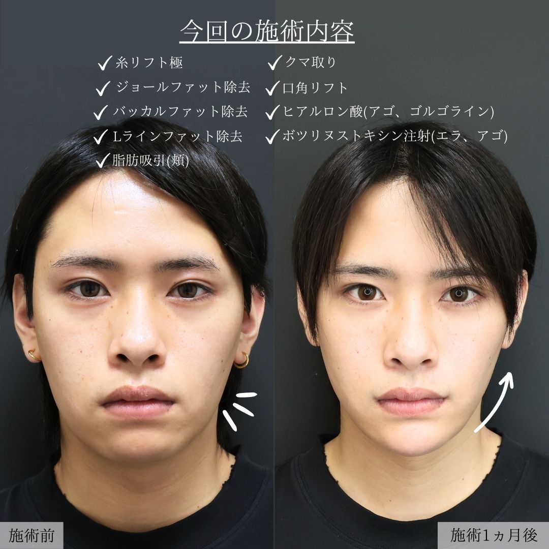 バッカルファット除去/エラボトックス注射/顎下の脂肪吸引の症例写真 施術前後 