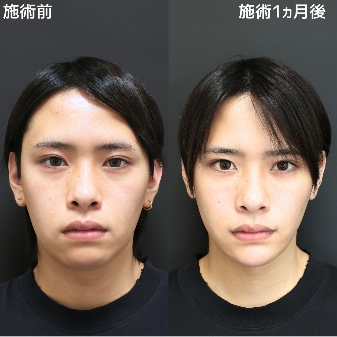 バッカルファット除去/エラボトックス注射/顎下の脂肪吸引の症例写真 施術前後 