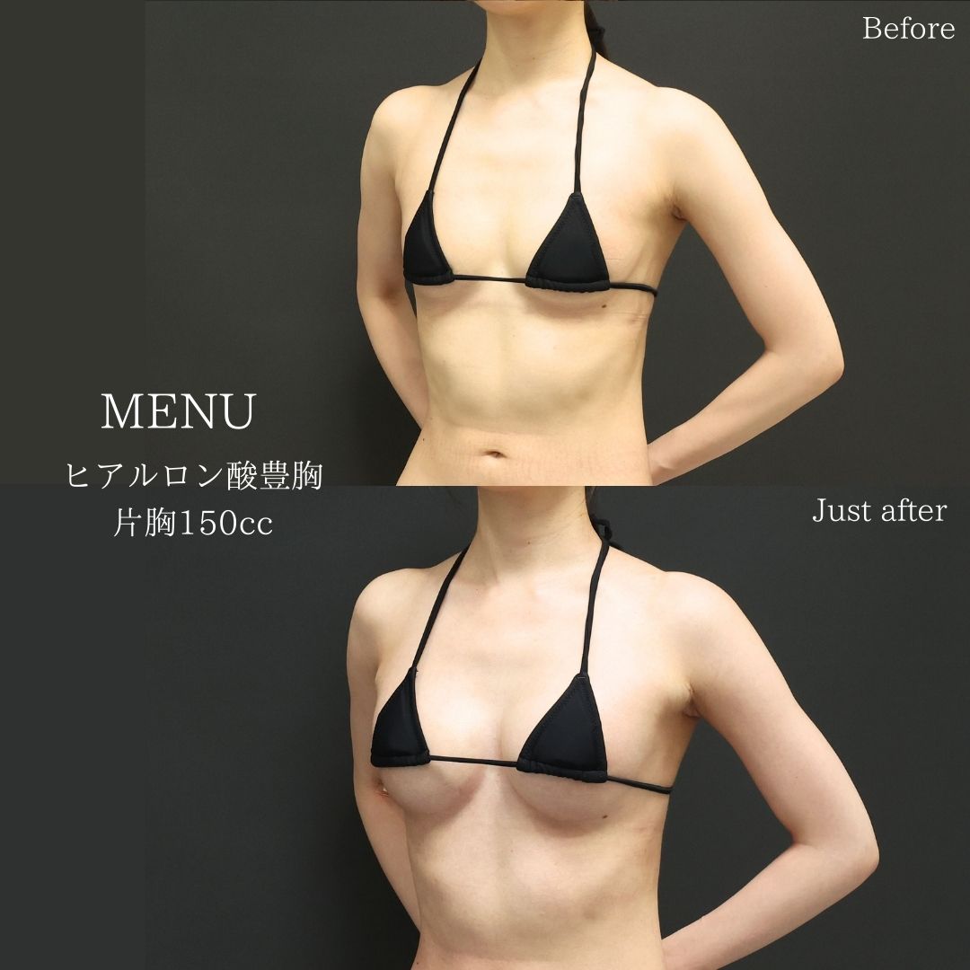 ヒアルロン酸注入豊胸術（グラビアバスト）の症例写真 施術前後 