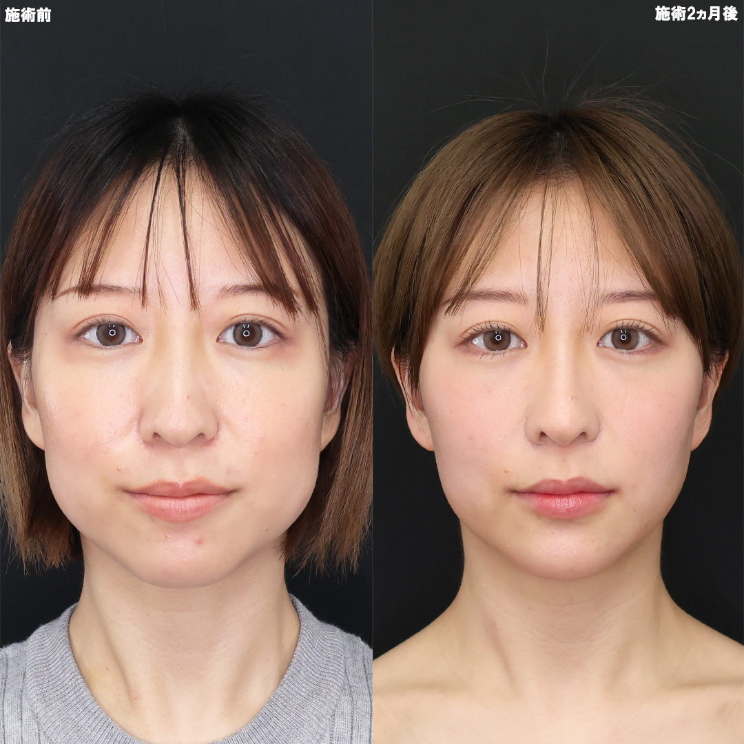 バッカルファット除去/TAC式 ツヤ肌コラーゲンリフト®/TAC式 ショッピングリフトの症例写真 施術前後 