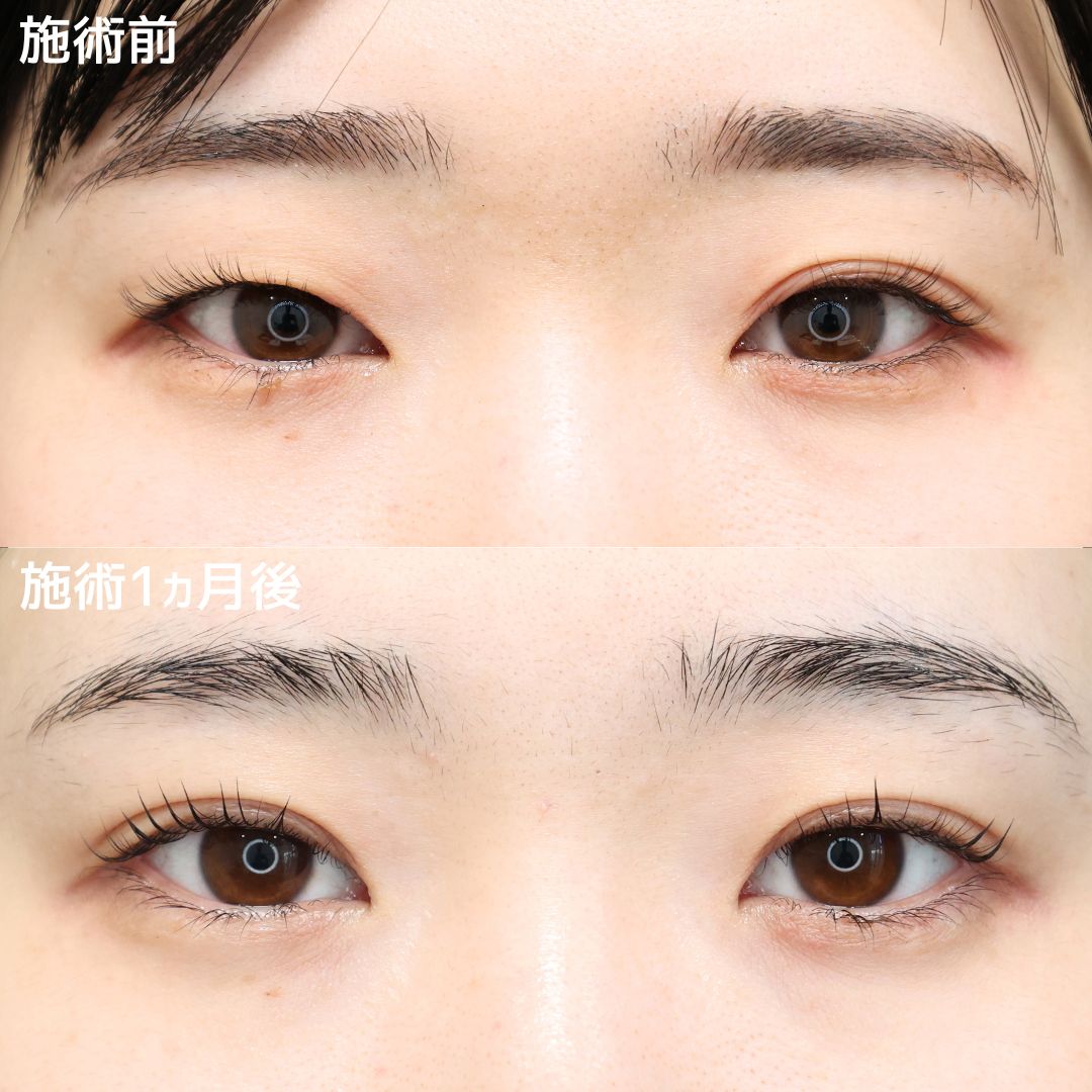 二重埋没法の症例写真 施術前後 