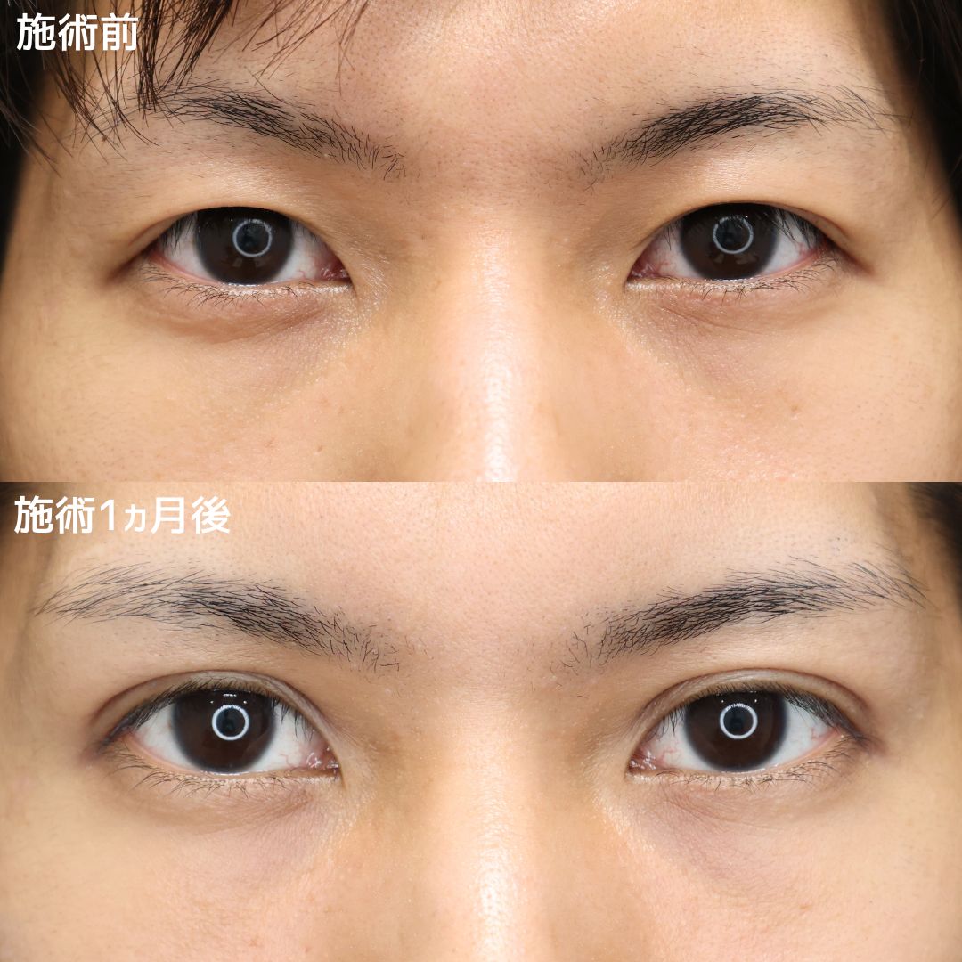 二重埋没法/ヒアルロン酸注射：その他/ボトックス注射：その他の症例写真 施術前後 